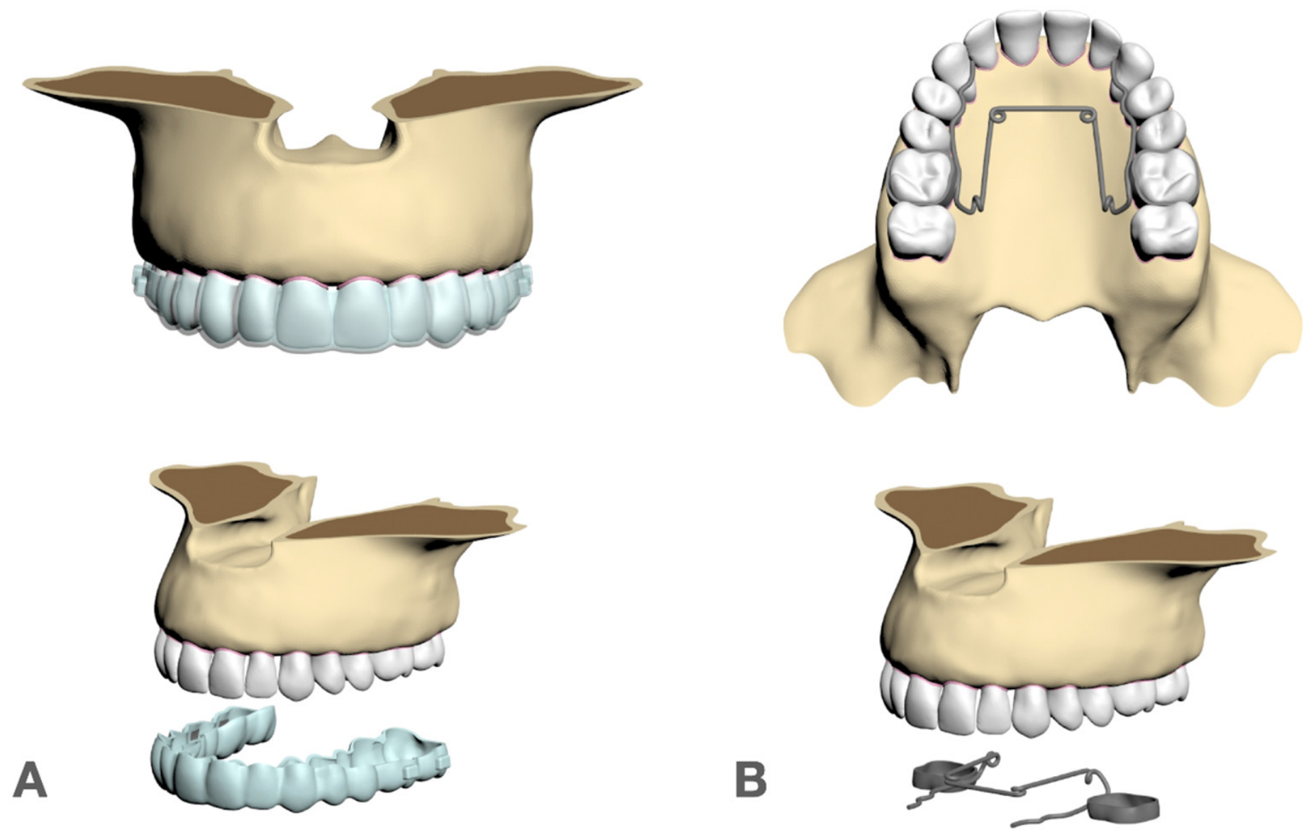 Biomechanical Evaluation of Clear Aligners and Quad-Helix in Maxillary ...