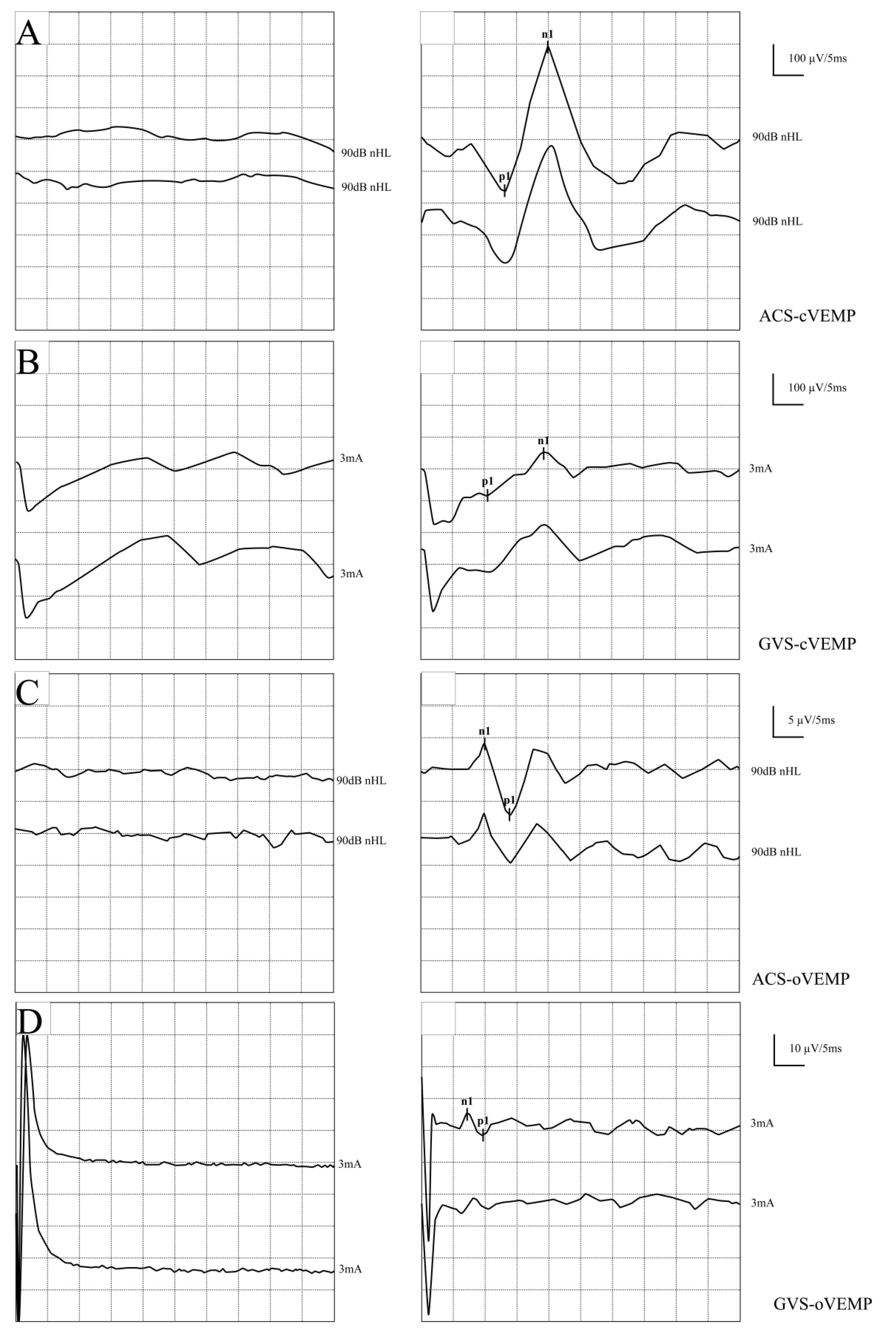 Vestibular Evoked Myogenic Potentials Reveal Impairments in Vestibular ...