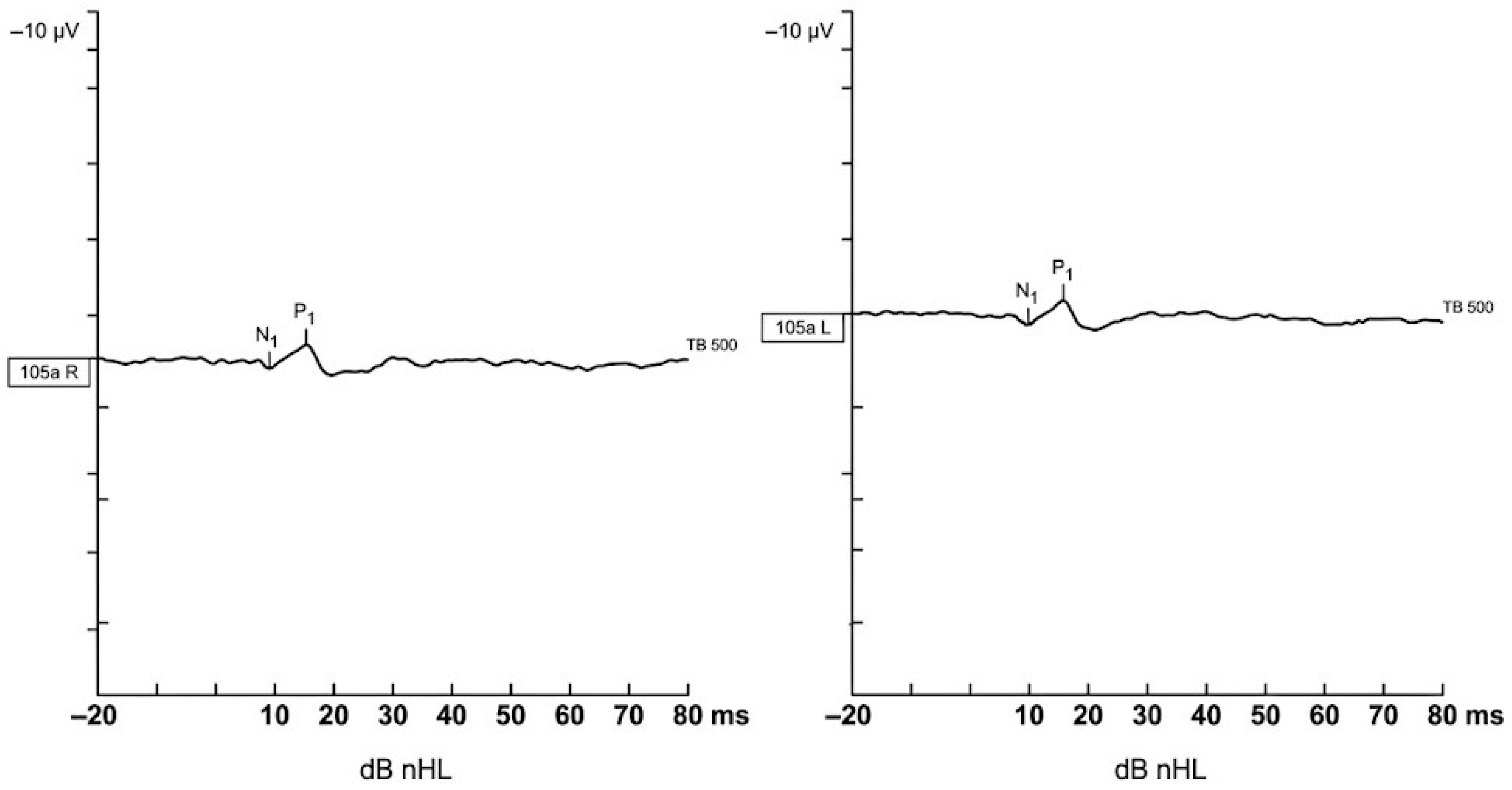 Cvemp Example Vestibular Evoked Myogenic Potentials (cVEMP and oVEMP) in Pregnancy: A ...