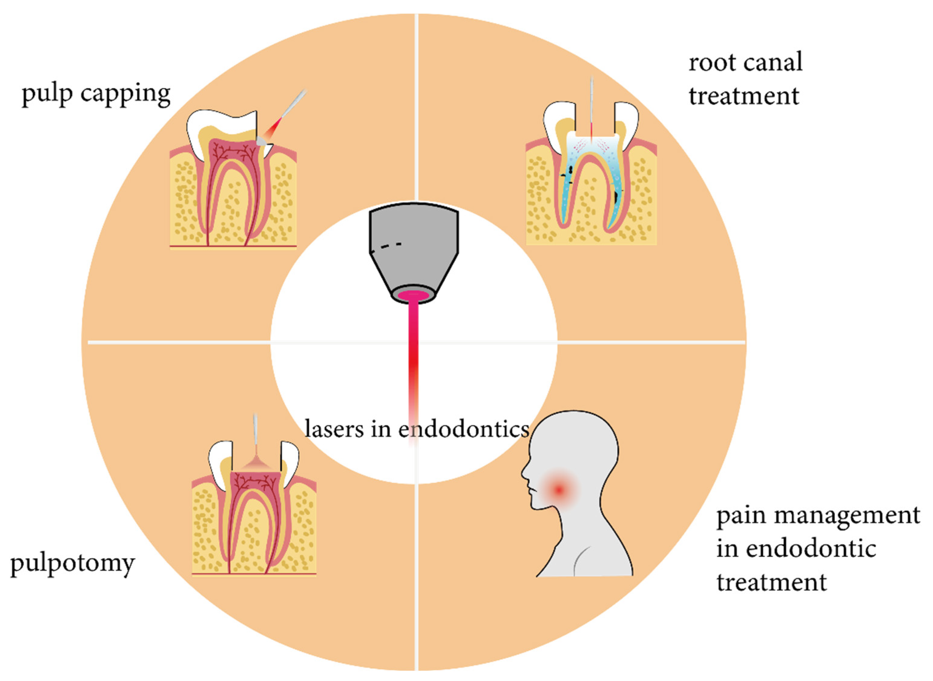 Root Canal Disinfection Using Highly Effective Aggregation-Induced