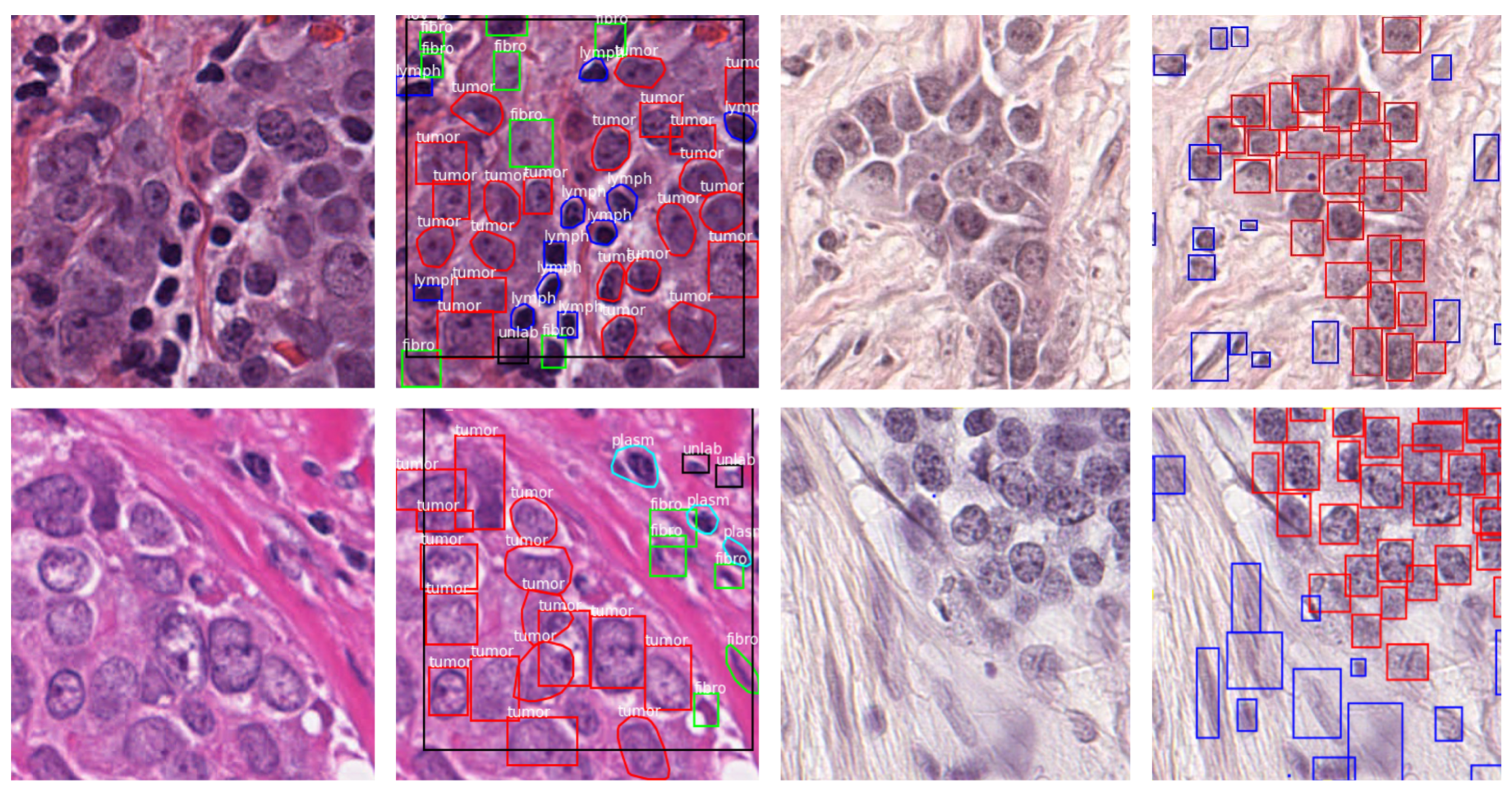 Clinical and pathological characteristics of AA and CAU breast cancer