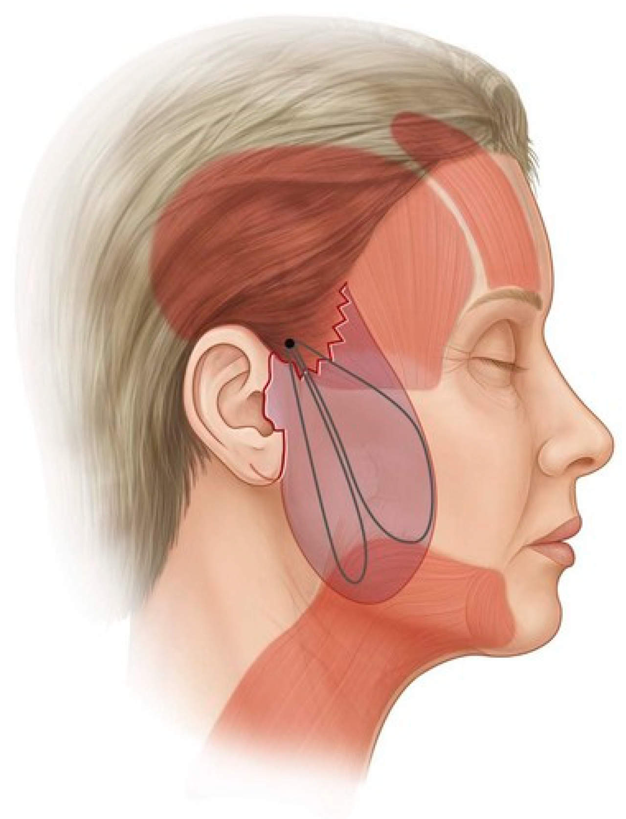 Proline purse string suture around the hernia neck. | Download Scientific  Diagram