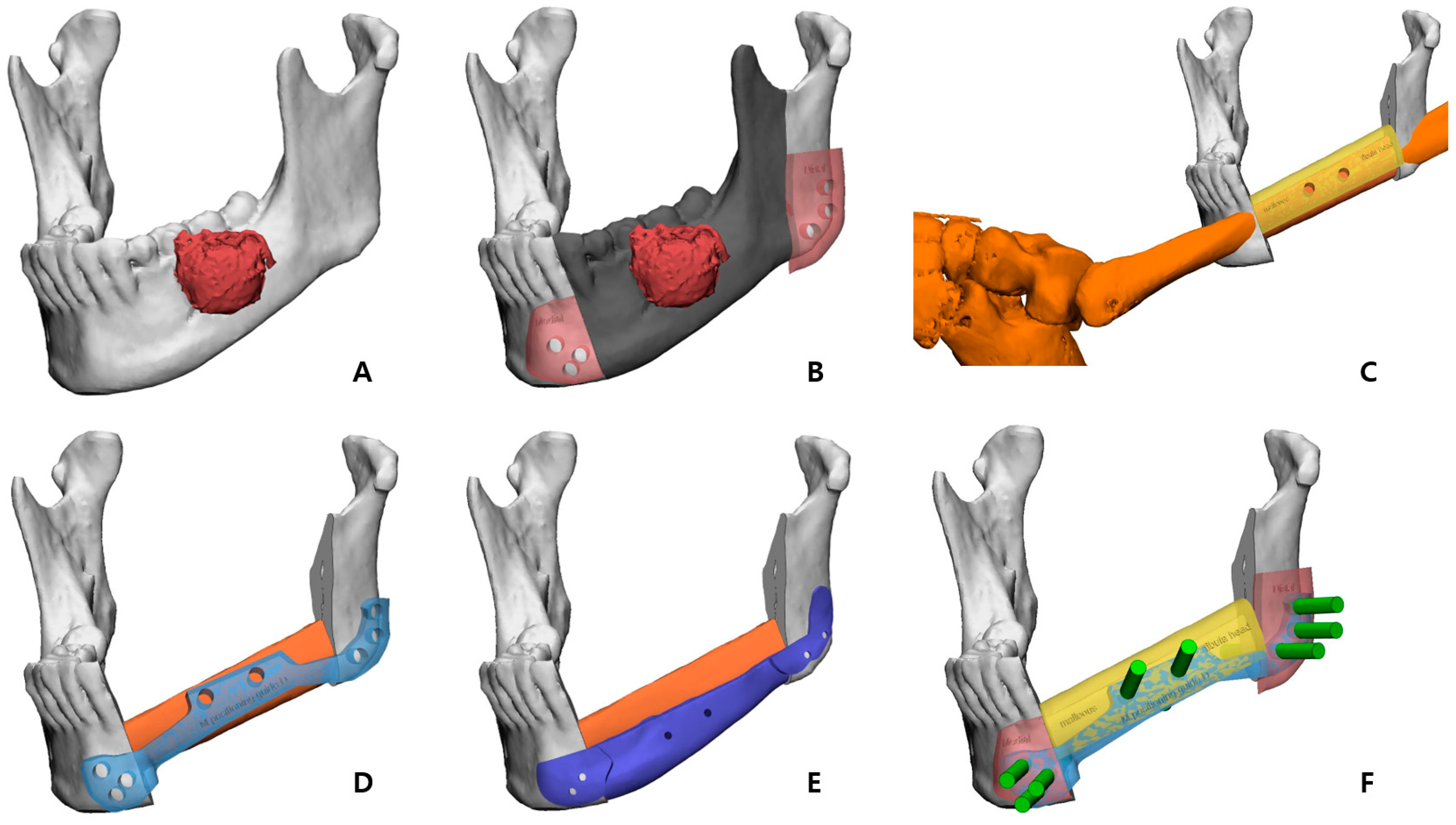 Long Term Follow Up Of A Novel Surgical Option Combining Fibula Free Long Term Follow Up Of A Novel Surgical Option Combining Fibula Free