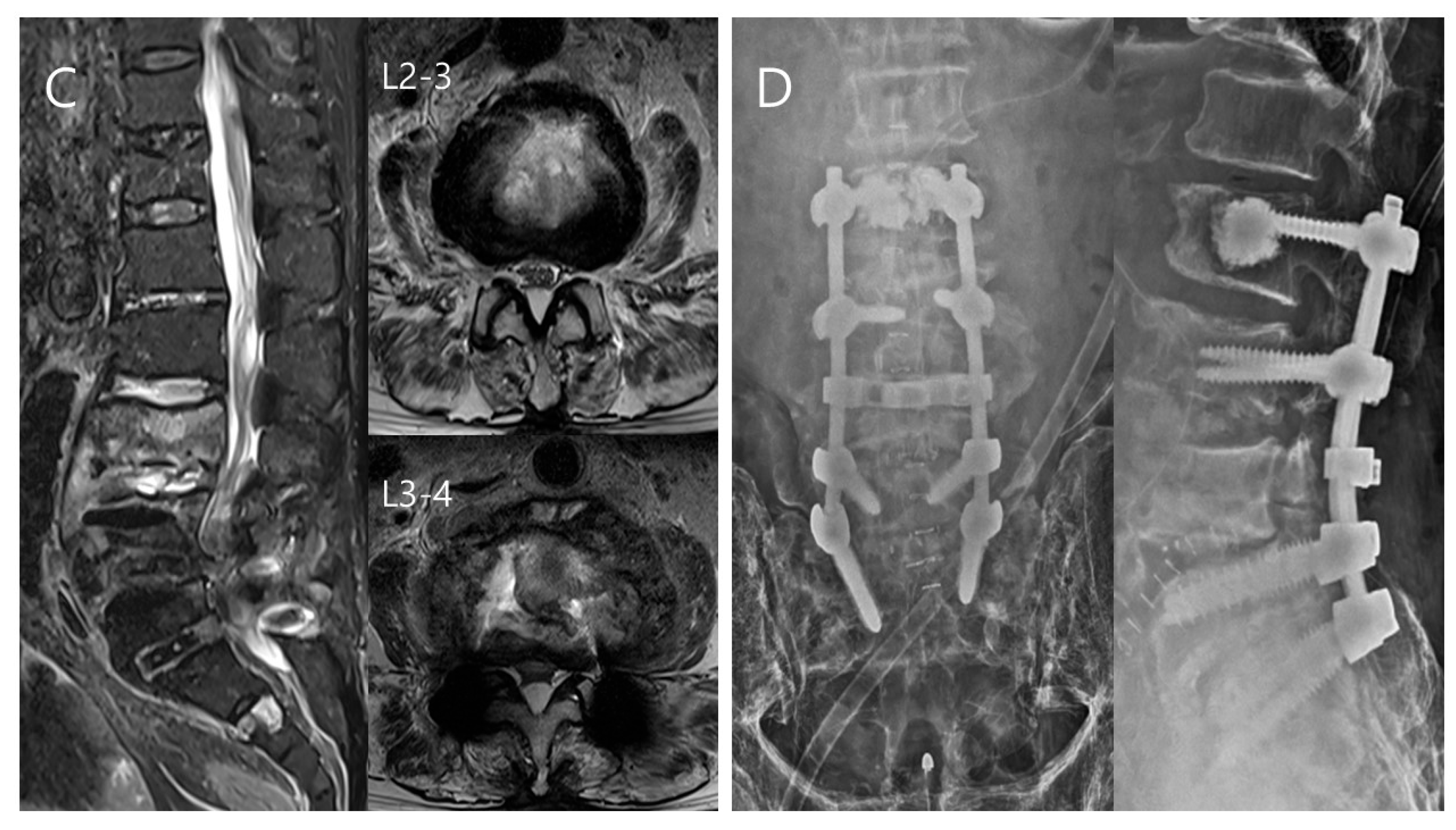 Association of tranexamic acid with decreased blood loss in patients  undergoing laminectomy and fusion with posterior instrumentation: a  systematic review and meta-analysis in: Journal of Neurosurgery: Spine  Volume 36 Issue 4 (2021) Journals