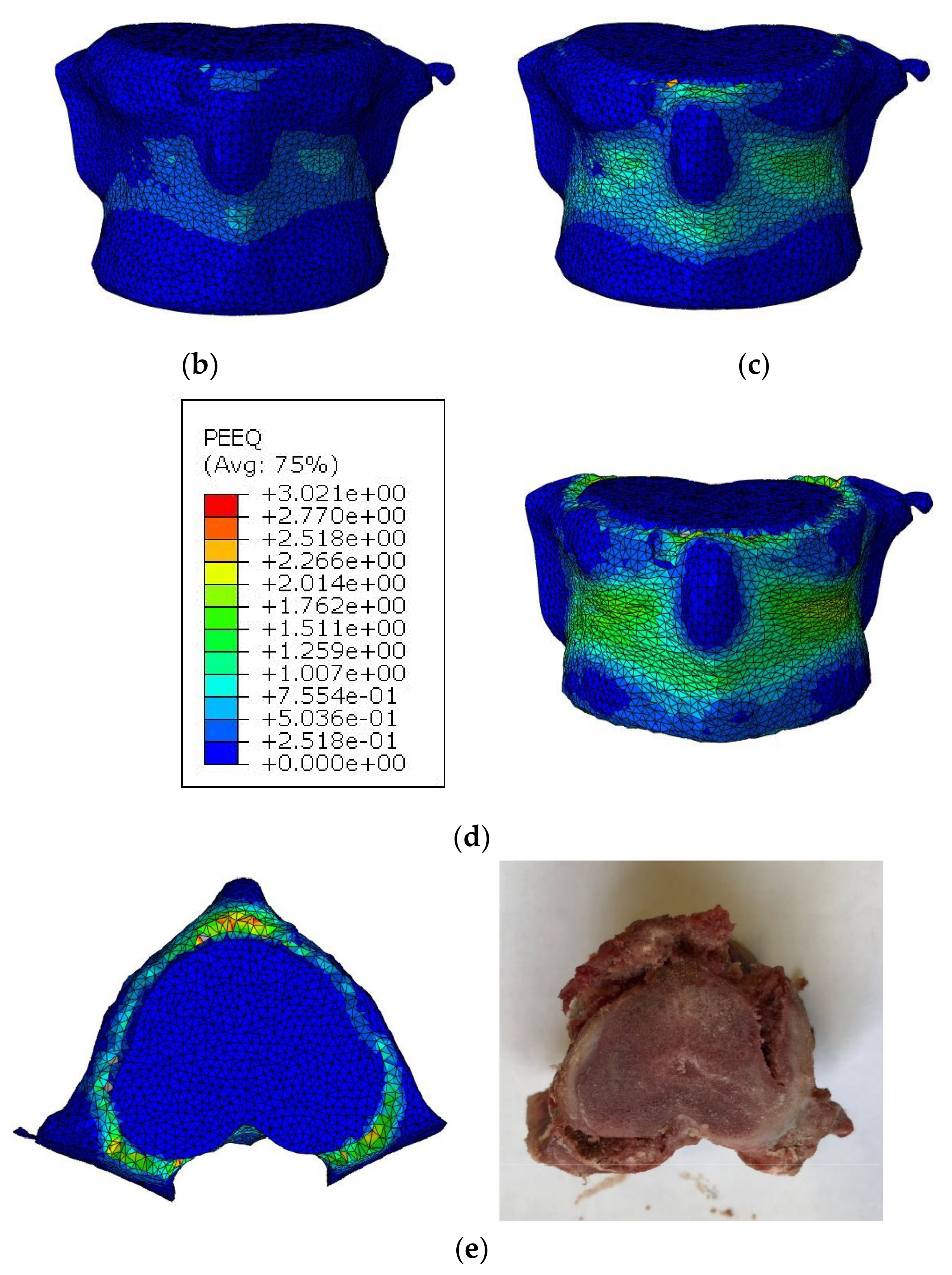 Finite element analysis of compression fractures at the