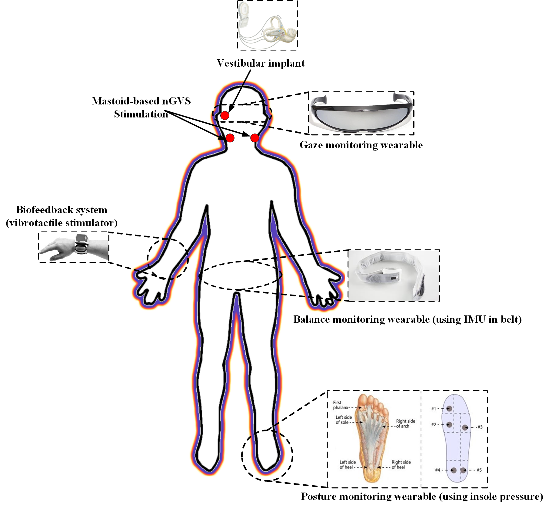 Bioengineering | Free Full-Text | Exploring the Potentials of Wearable  Technologies in Managing Vestibular Hypofunction