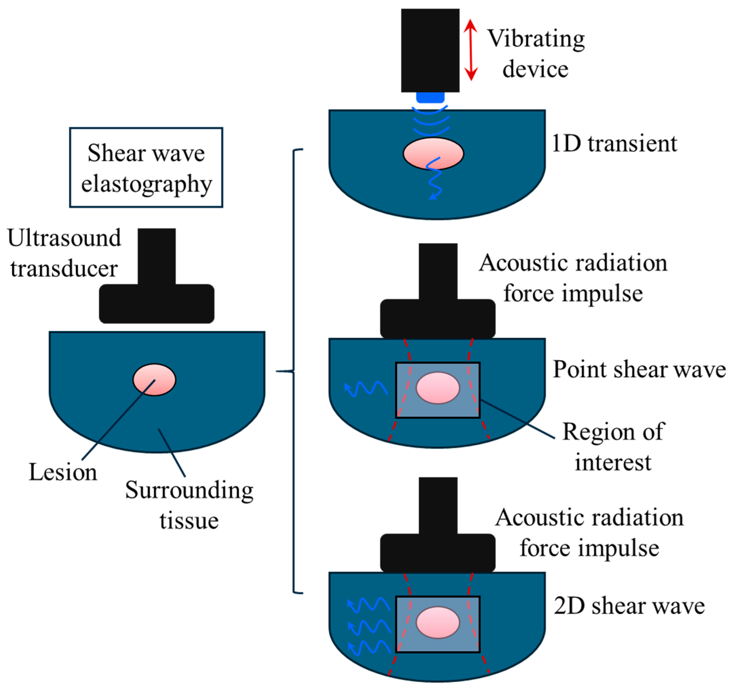 Mathematical Models For Ultrasound Elastography Recent Advances To Mathematical Models For Ultrasound Elastography Recent Advances To