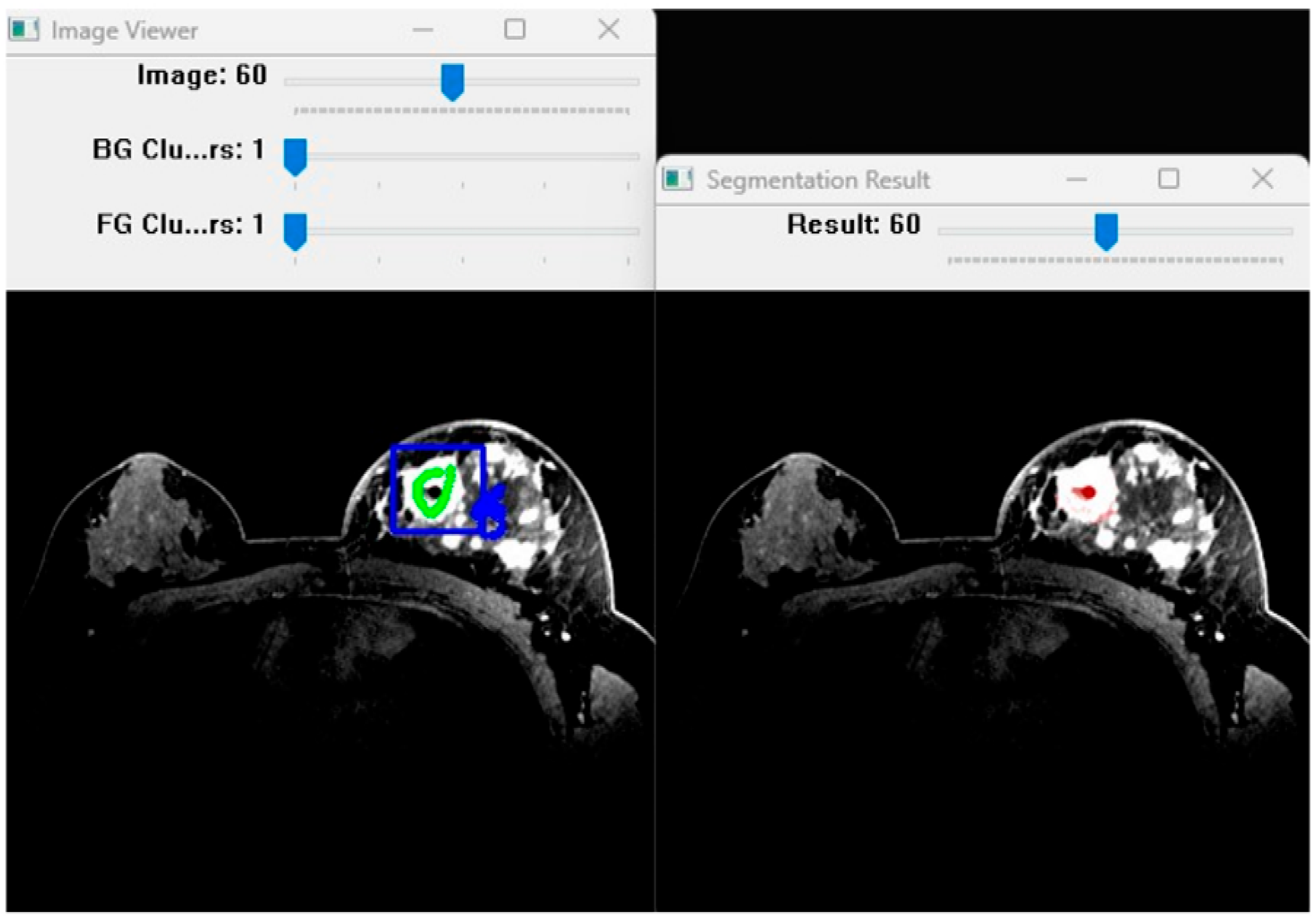 3D Medical Image Segmentation with 3D Modelling