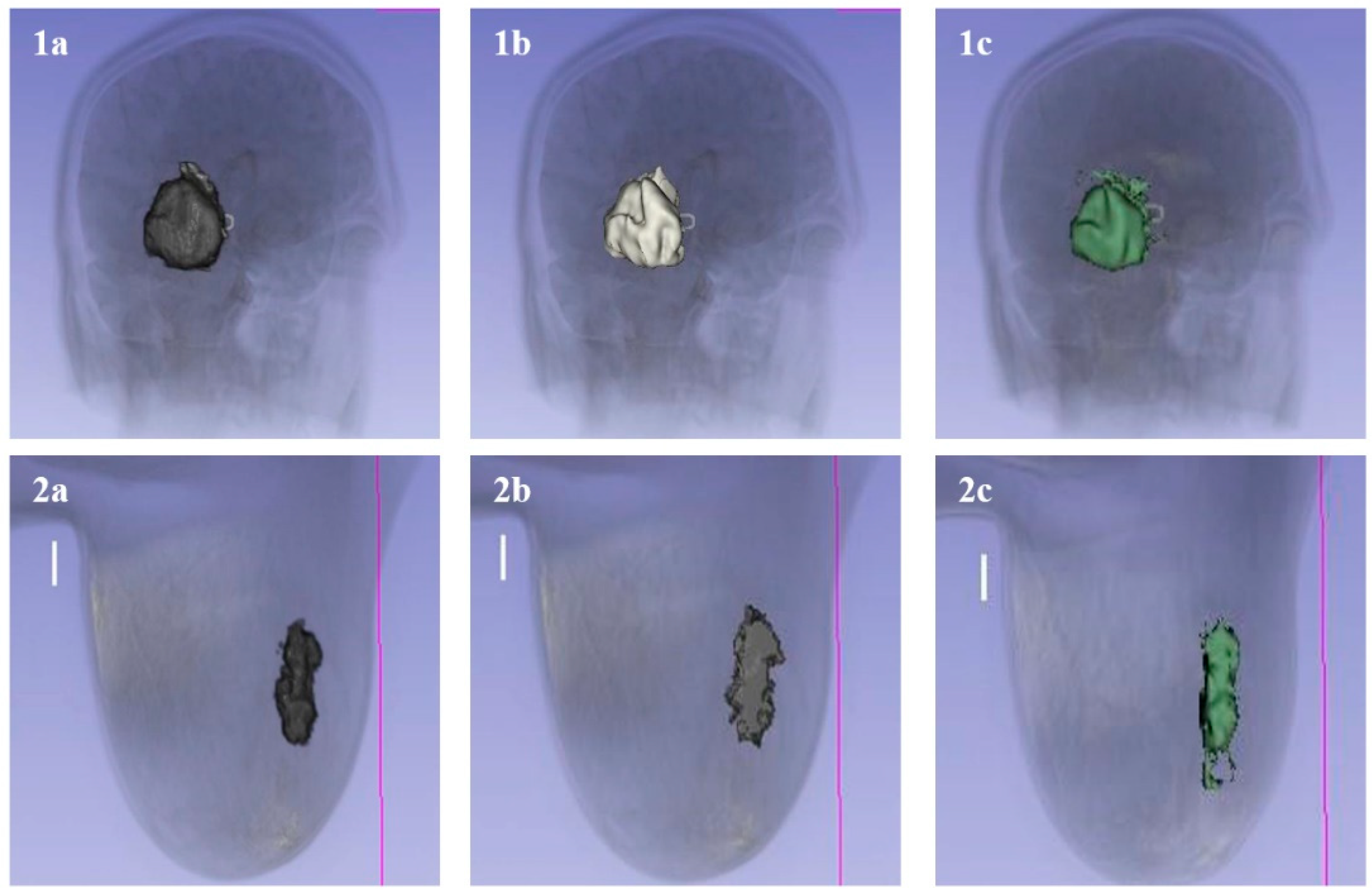 3D Medical Image Segmentation with 3D Modelling