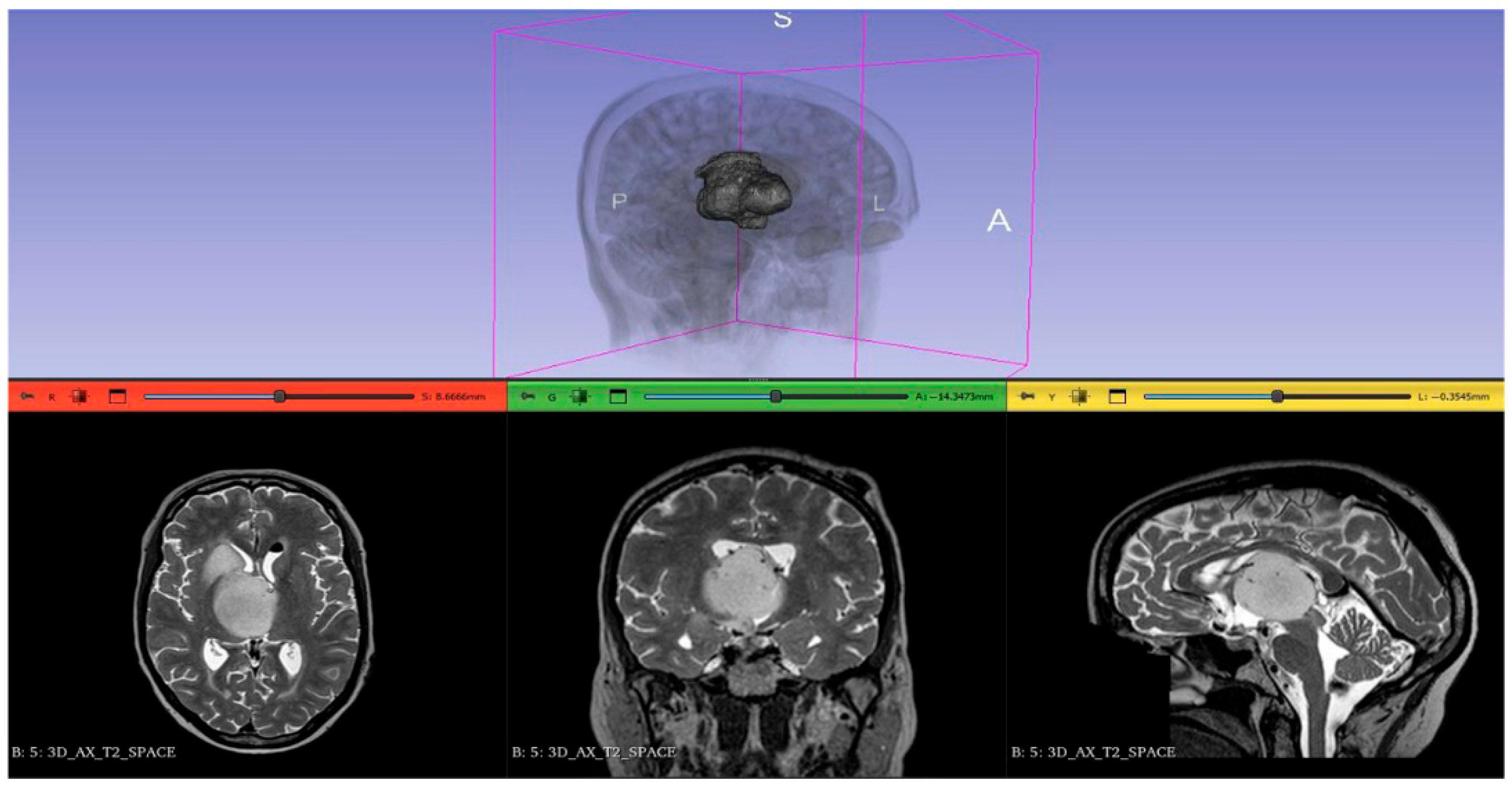 3D Medical Image Segmentation with 3D Modelling