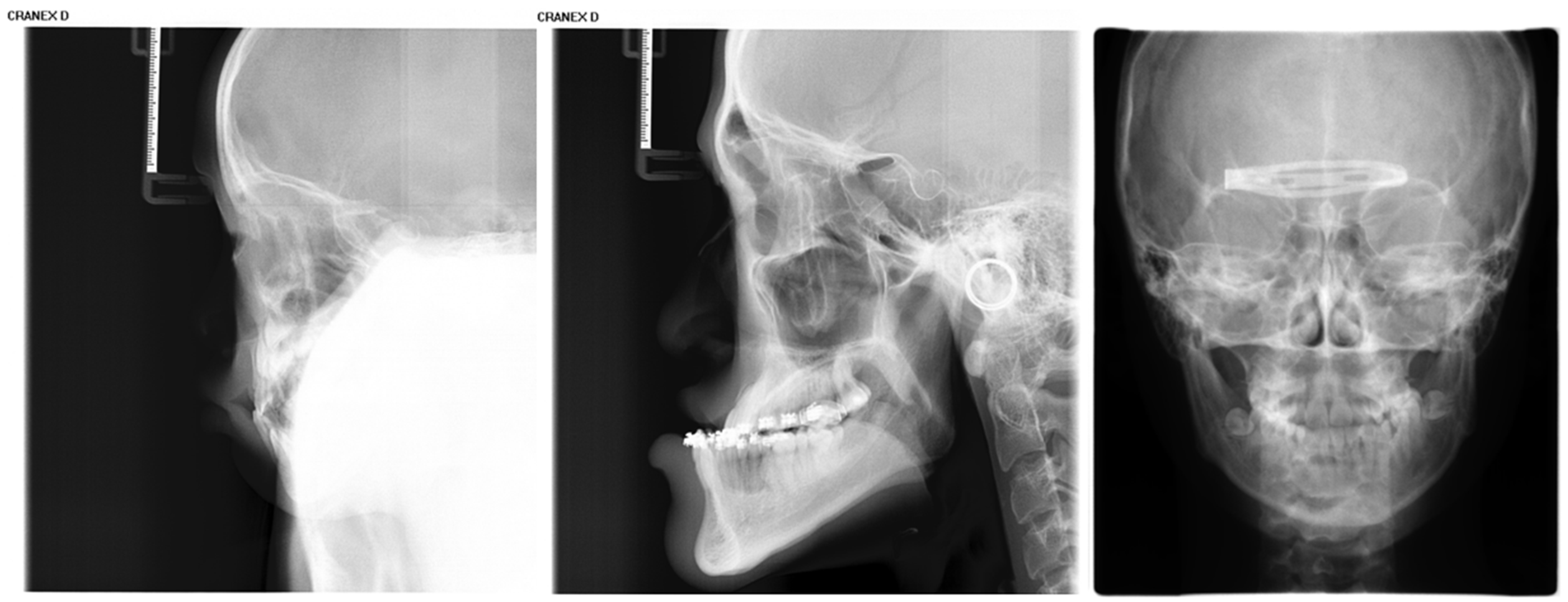 Quantification of Craniofacial Growth Pattern Based on Deep Learning