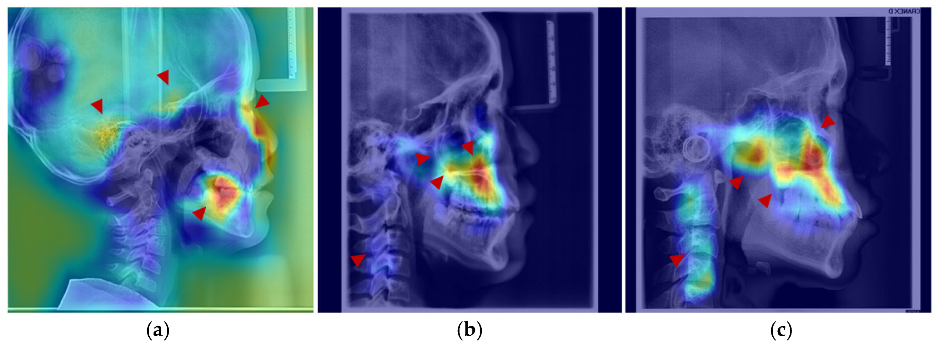 Quantification of Craniofacial Growth Pattern Based on Deep Learning