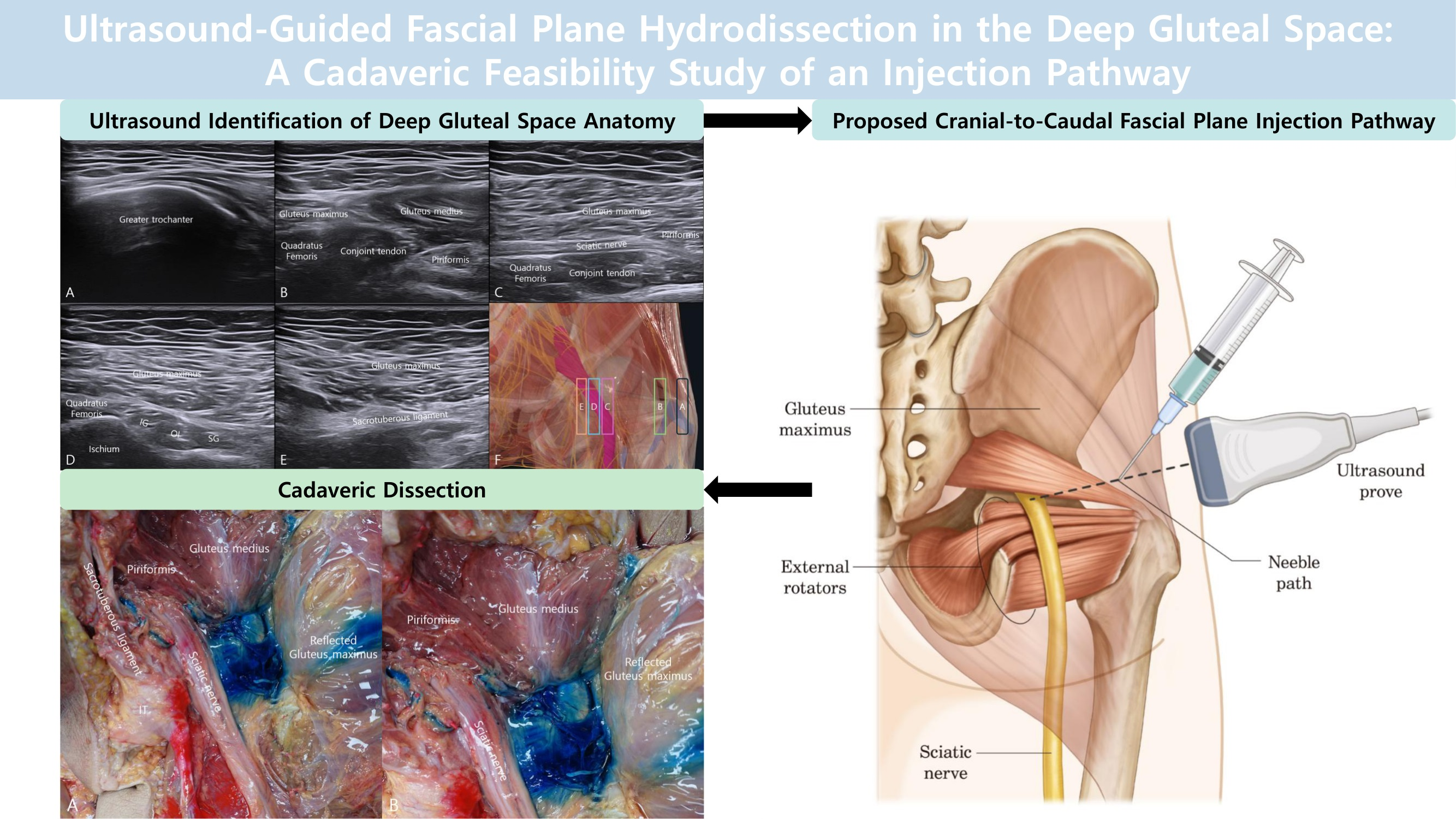 Sa Space Injection An Anatomical Cadaveric Demonstration of an Ultrasound-Guided Fascial ...