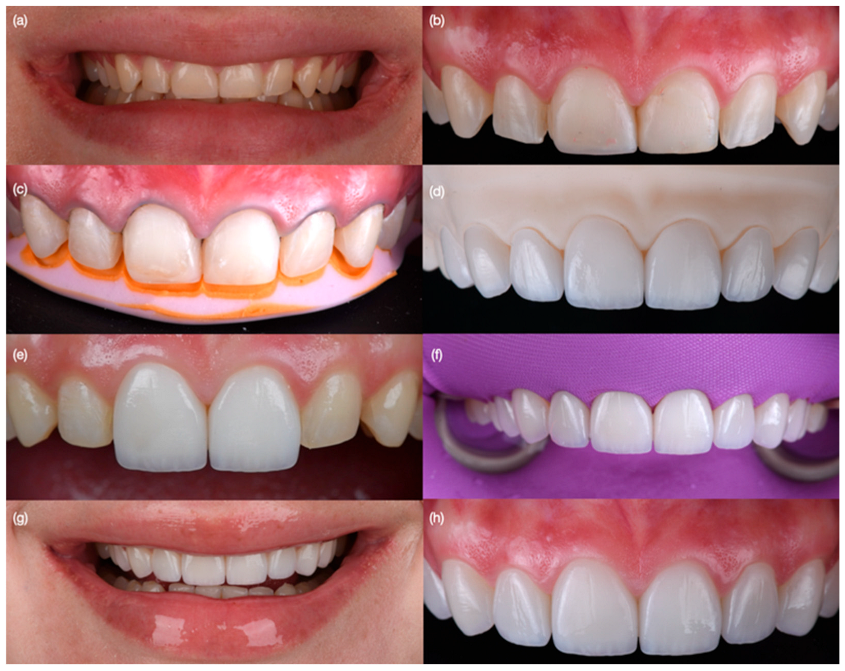White Esthetic Score as a Tool for Esthetic Assessment of Tooth ...