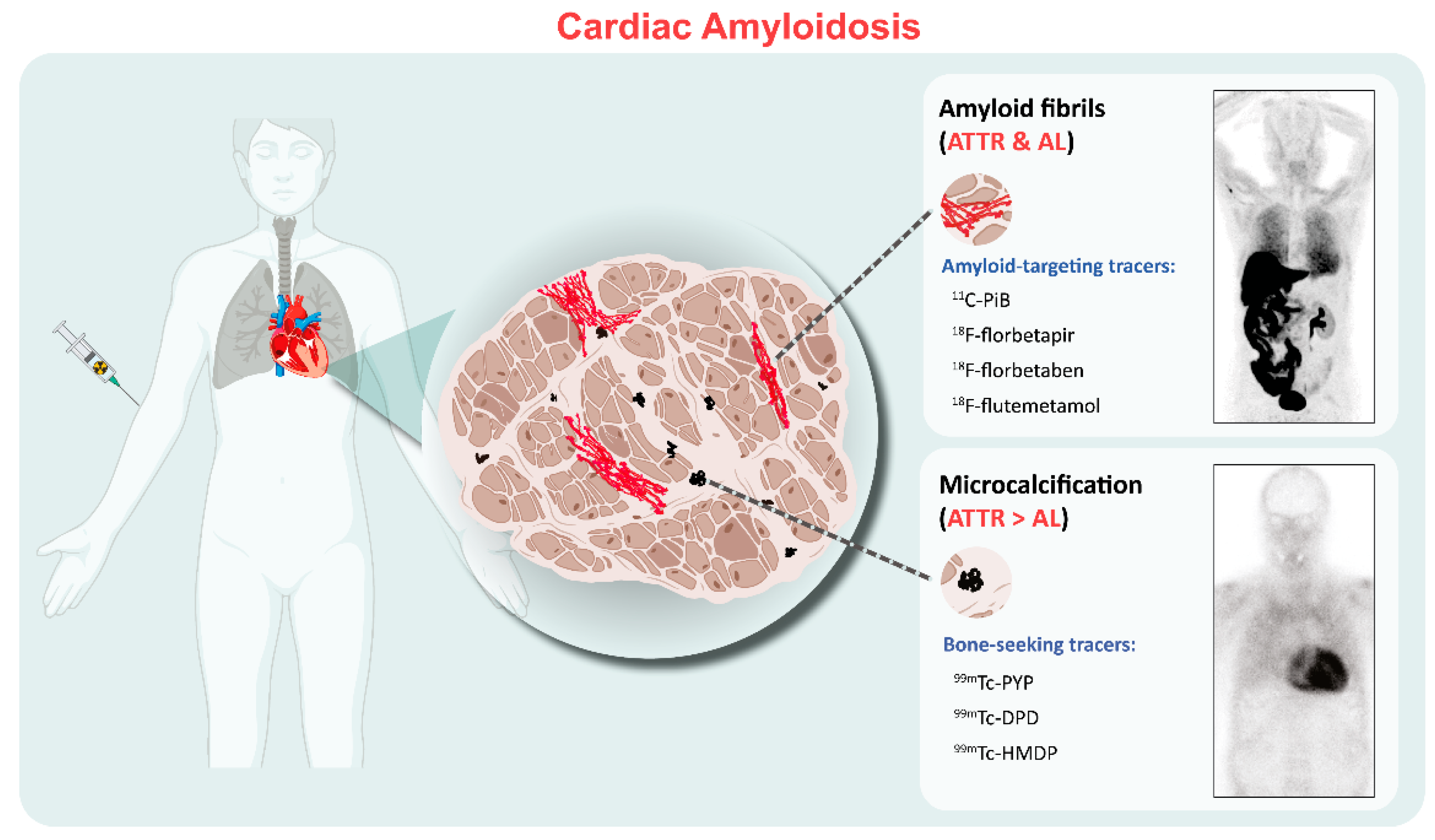 Frontiers  Cardiac Amyloidosis: A Review of Current Imaging Techniques