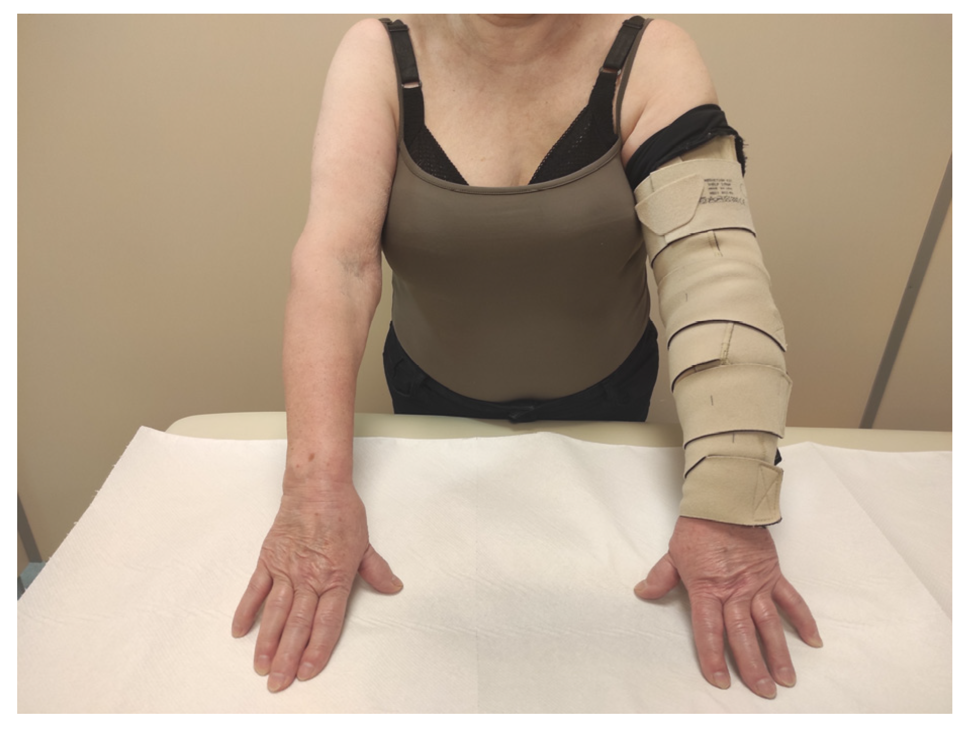 Mastectomy Compression Arm Sleeve, Wearing Tightly Lymphedema Arm