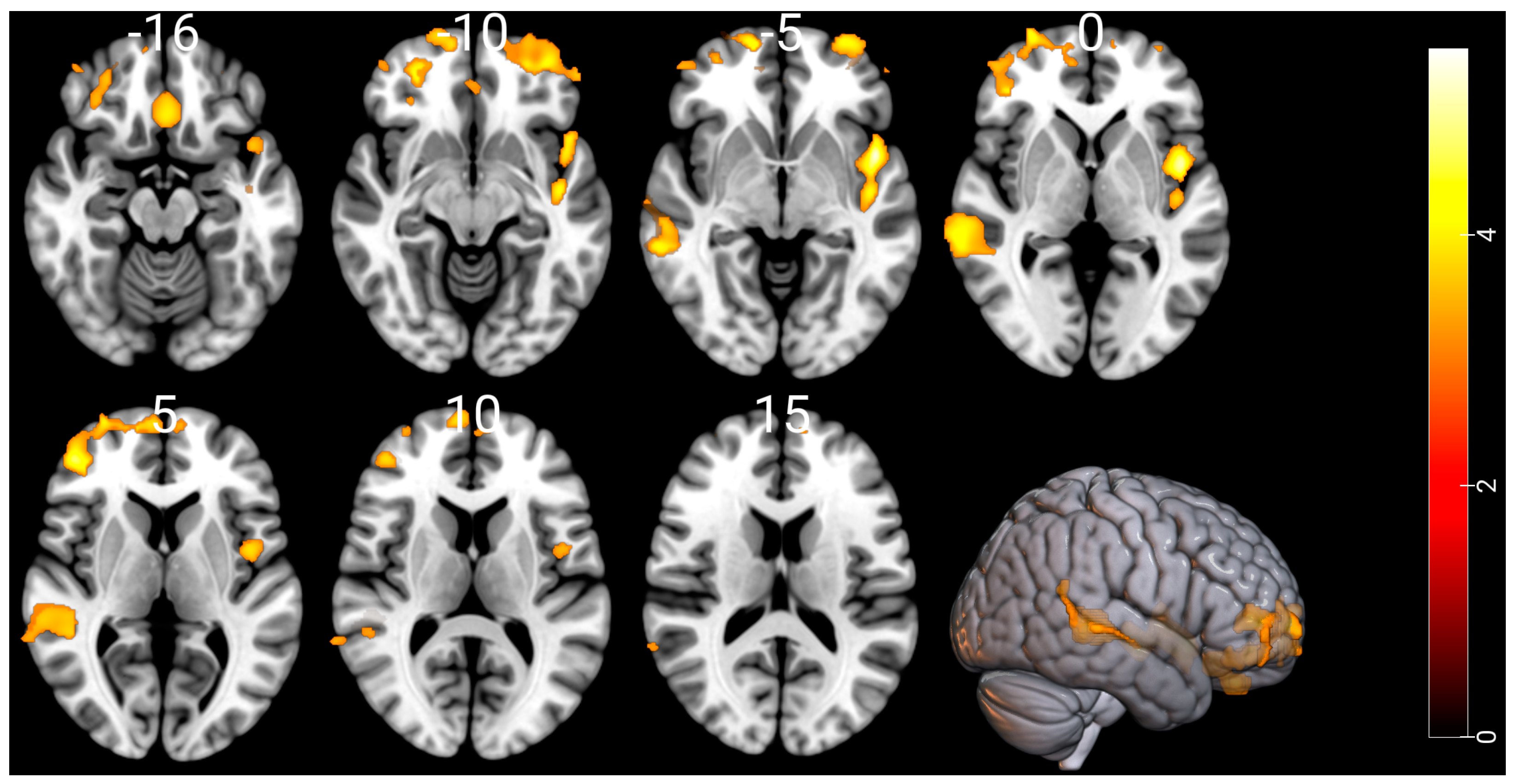 Brain aging in major depressive disorder: results from the ENIGMA