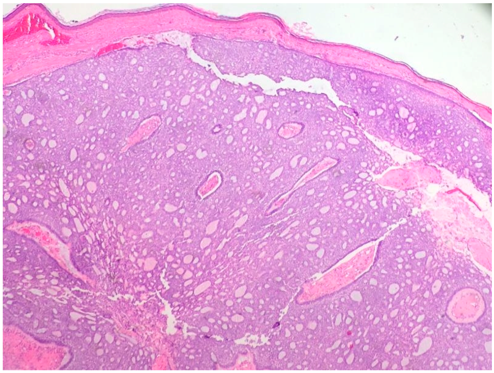 merkel cell carcinoma histology