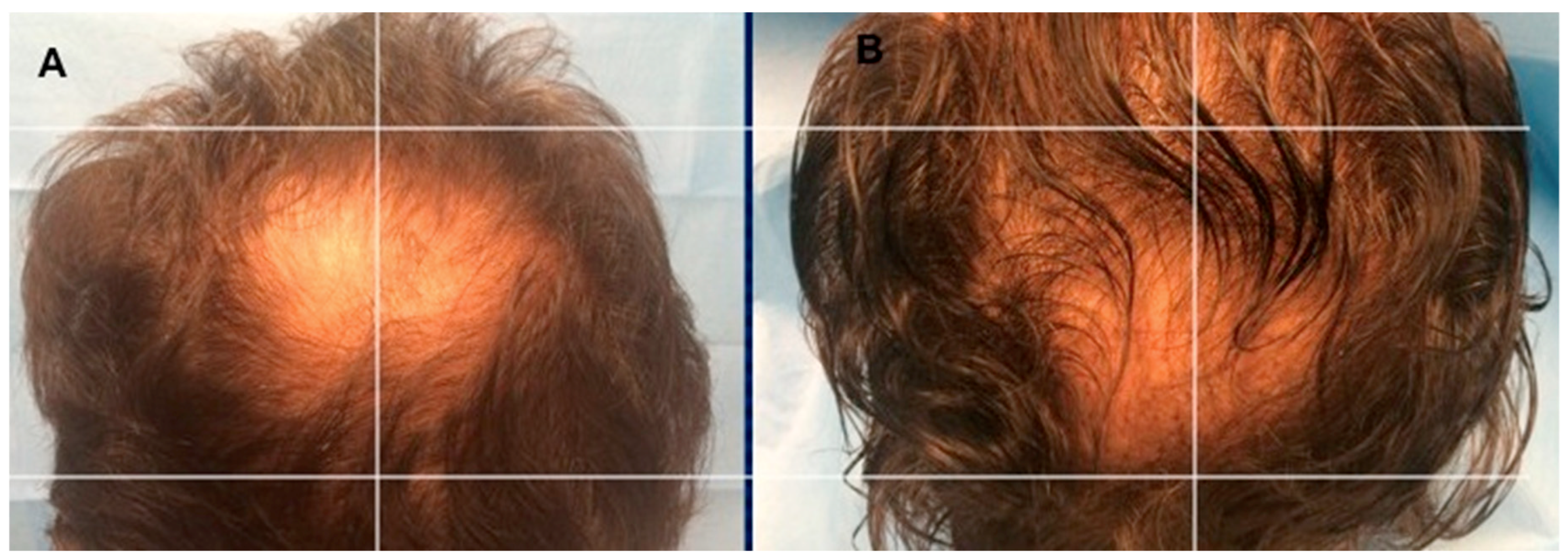 Biomedicines | Free Full-Text | Platelet-Rich Plasma and Micrografts  Enriched with Autologous Human Follicle Mesenchymal Stem Cells Improve Hair  Re-Growth in Androgenetic Alopecia. Biomolecular Pathway Analysis and  Clinical Evaluation