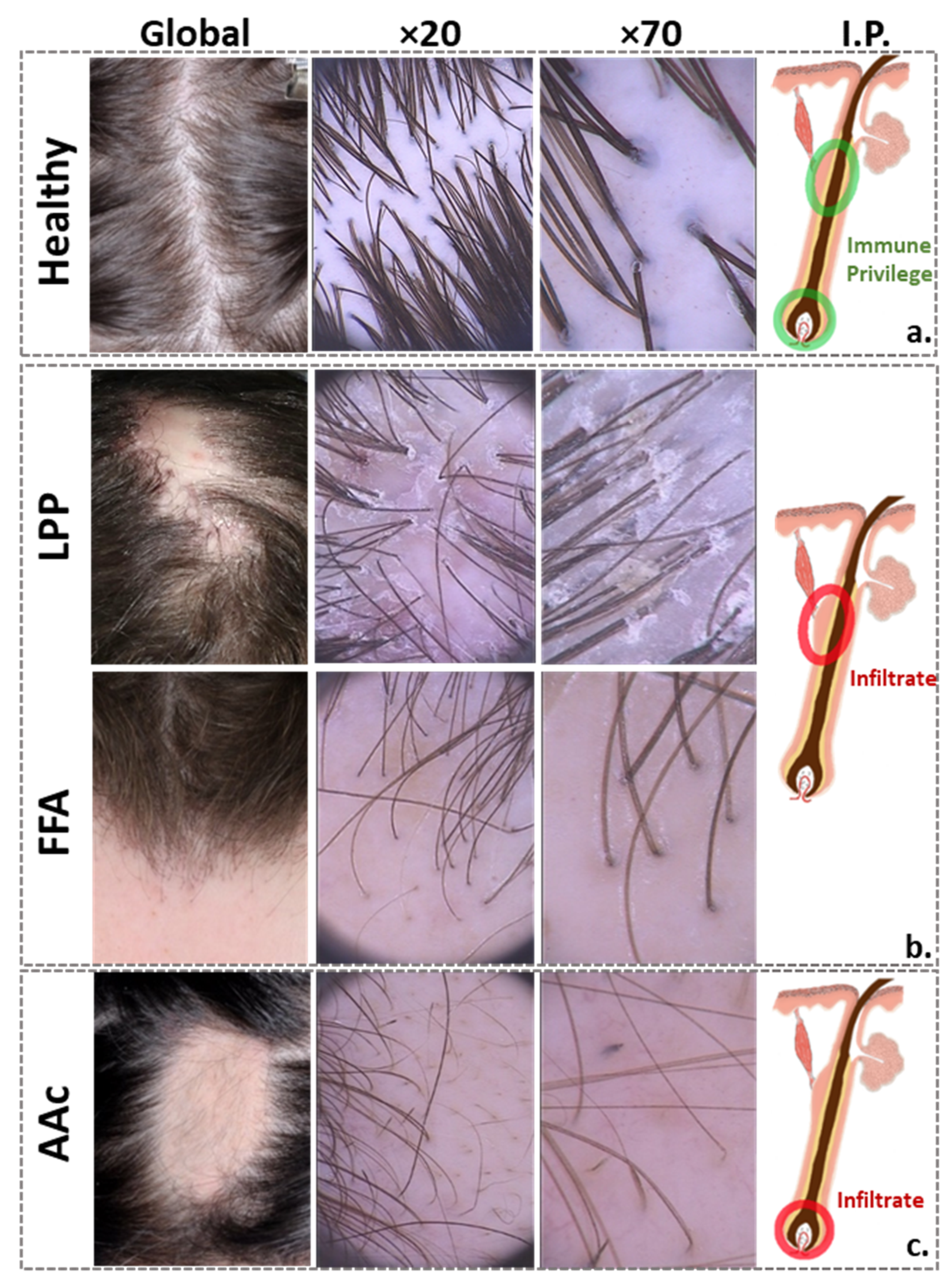Biomedicines | Free Full-Text | Dysbiosis and Enhanced Beta-Defensin  Production in Hair Follicles of Patients with Lichen Planopilaris and  Frontal Fibrosing Alopecia