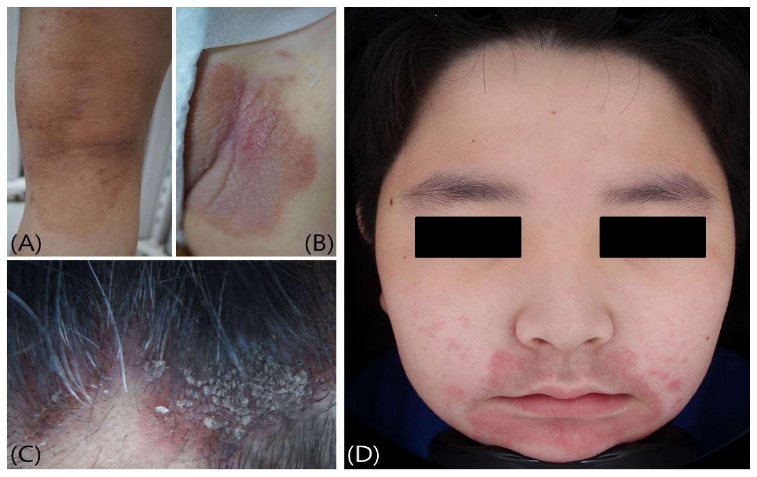 Biomedicines Free Full-Text Differential Diagnosis and Treatment of Itching in Children and Adolescents image picture