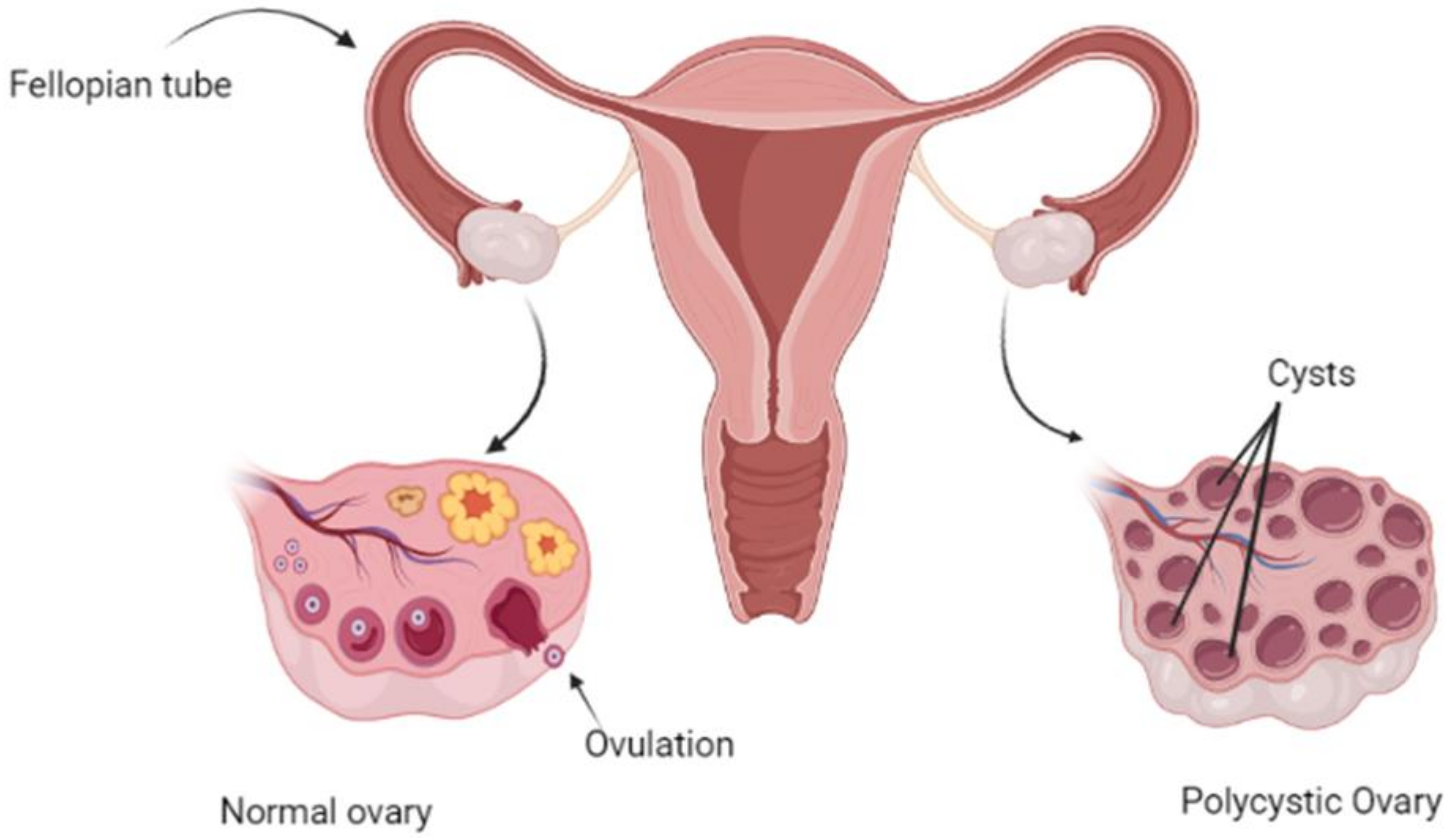 Biomedicines | Free Full-Text | Polycystic Ovarian Syndrome: A Complex Disease with a Genetics Approach