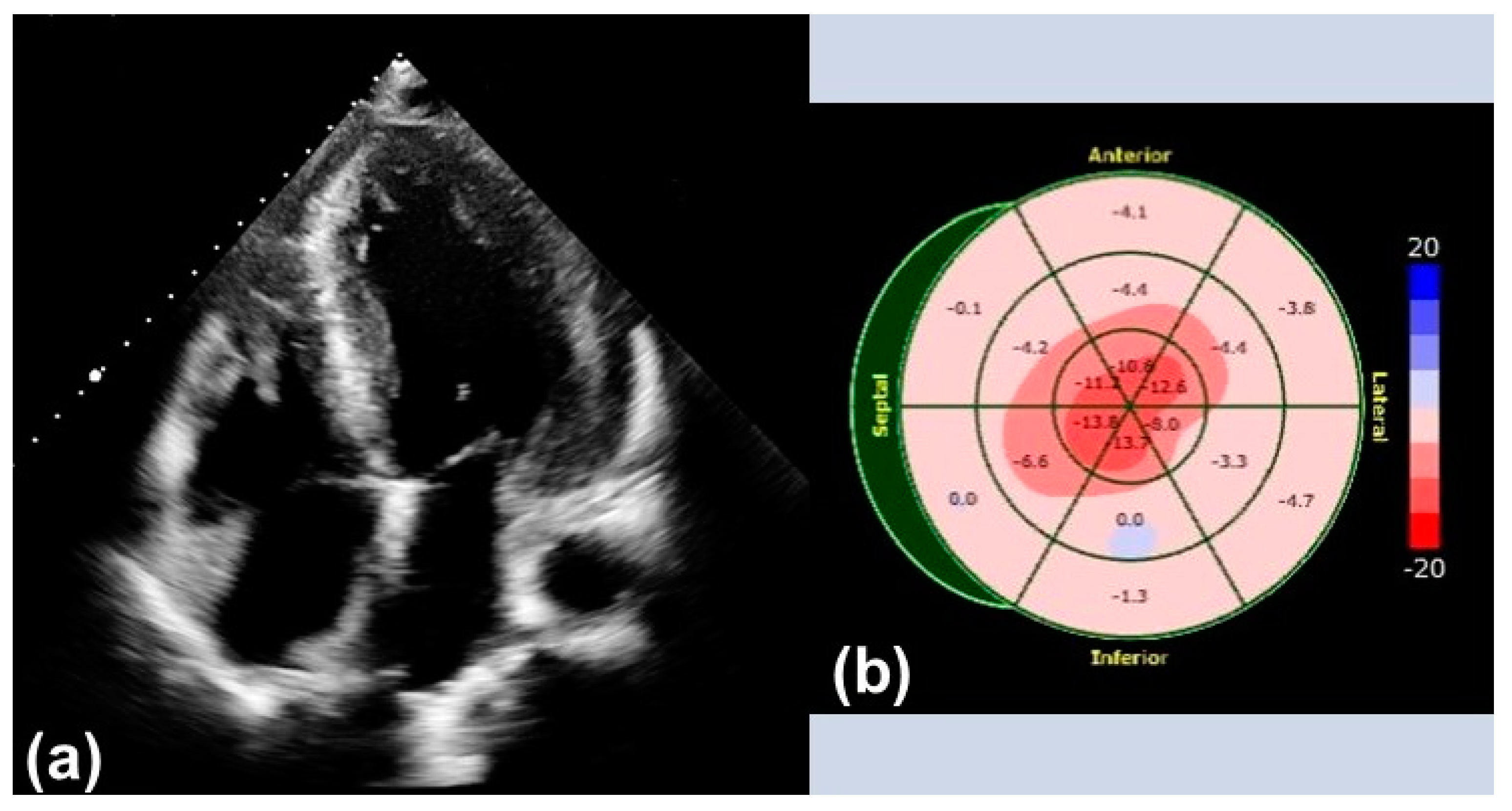 Cardiac imaging - Abnormal global longitudinal strain with apical sparing  (cherry on top) pattern in cardiac amyloidosis (sensitivity 93% and  specificity 82%). #echofirst #cardiacamyloidosis