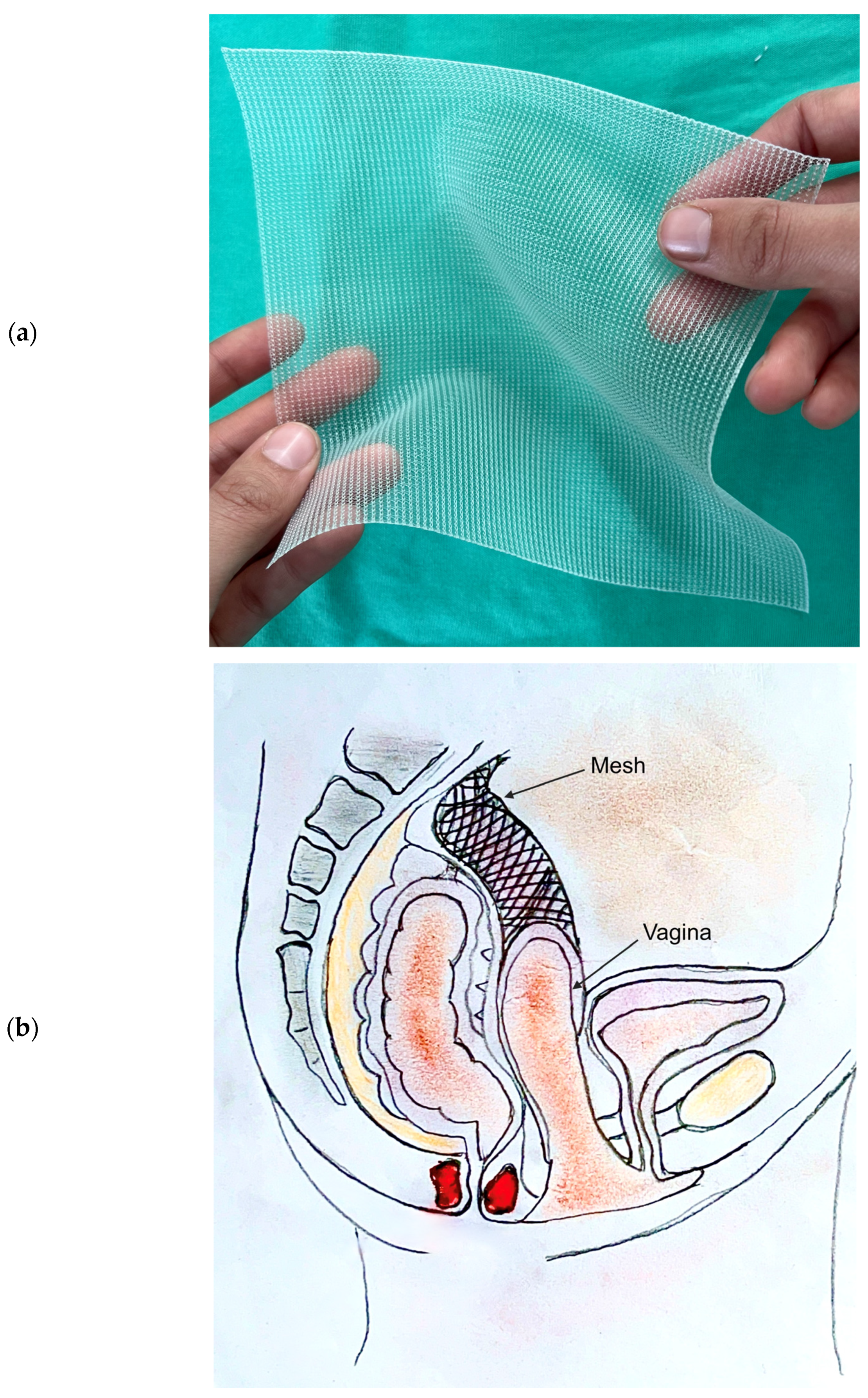 naked hosewives types of vaginal sling
