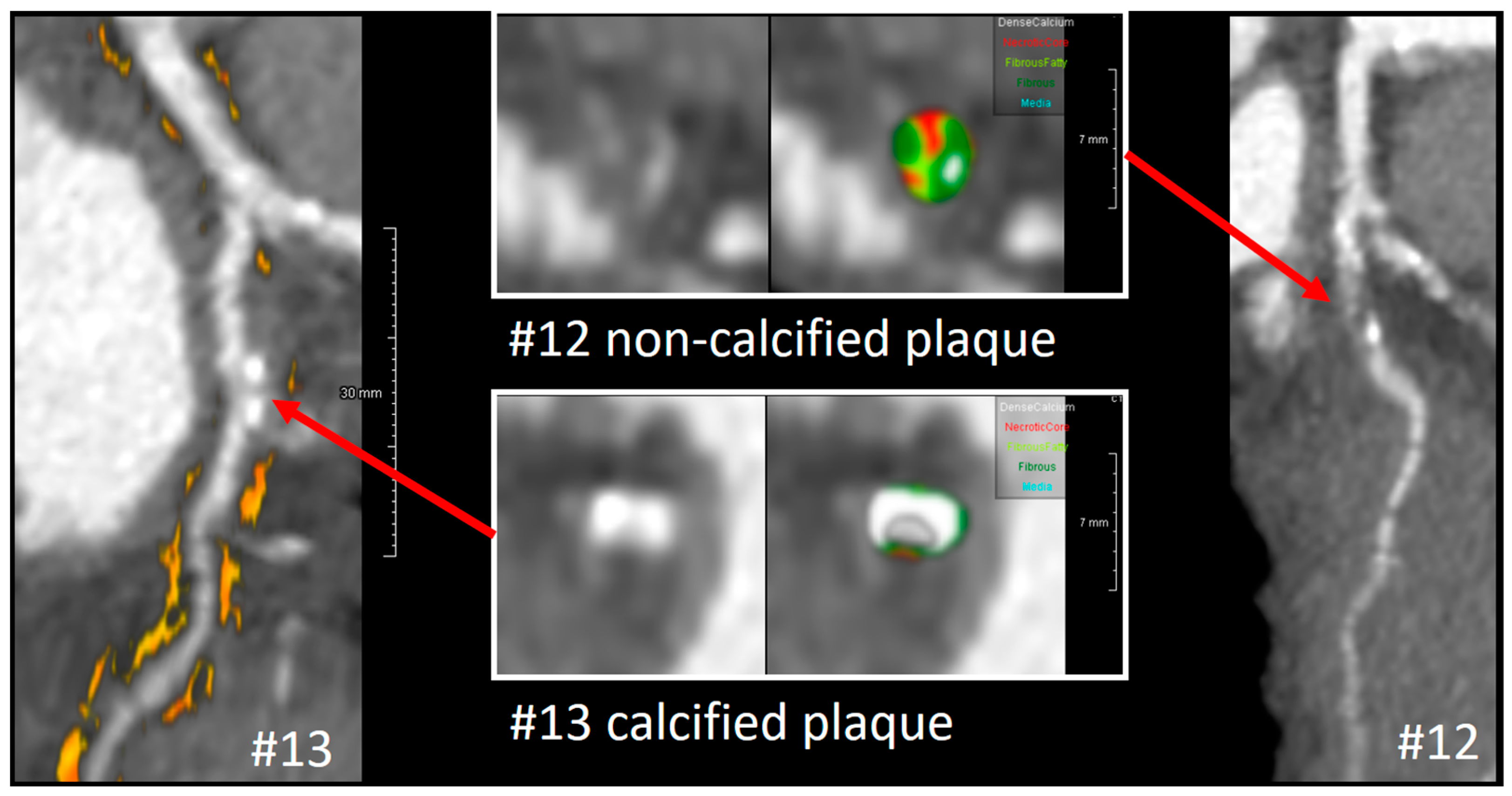 Frontiers | Commentary: Plaque Features and Epicardial Fat Volume for  Cardiovascular Risk Assessment—A Key Role With Cardiac Computed Tomography?
