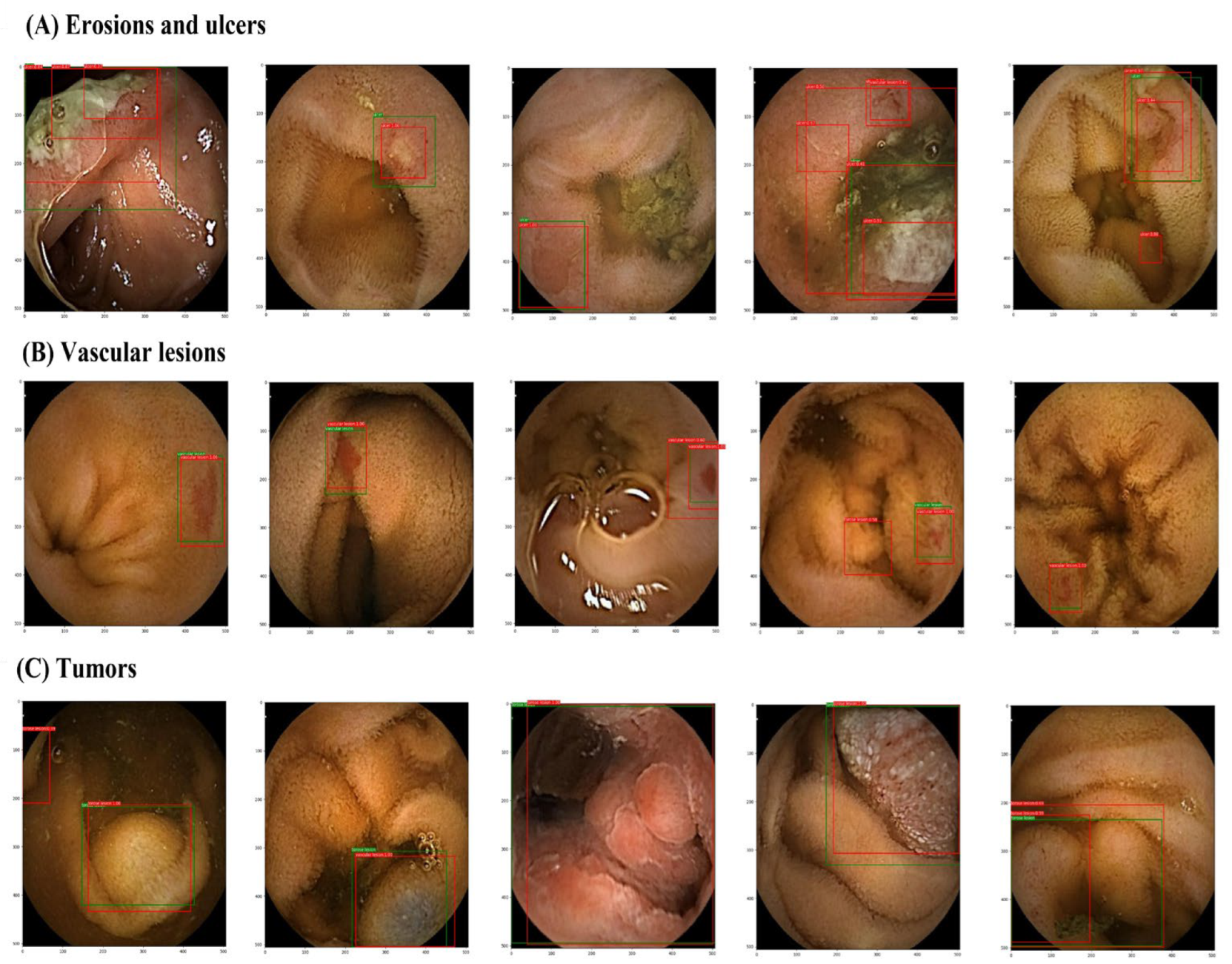 ID: 3526558 ARTIFICIAL INTELLIGENCE AND COLON CAPSULE ENDOSCOPY: AUTOMATIC  DETECTION OF COLONIC PROTUBERANT LESIONS USING A CONVOLUTIONAL NEURAL  NETWORK - Gastrointestinal Endoscopy