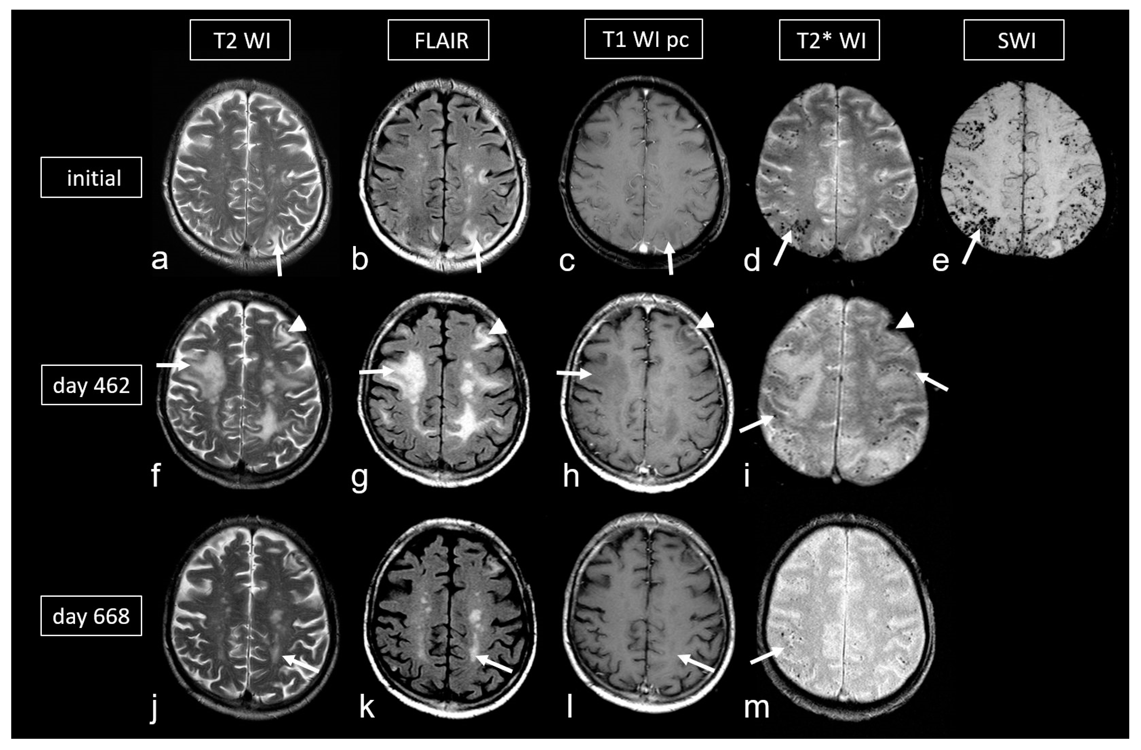 Cerebral Amyloid Angiopathy Clinical Presentation Sequelae And Cerebral Amyloid Angiopathy Clinical Presentation Sequelae And