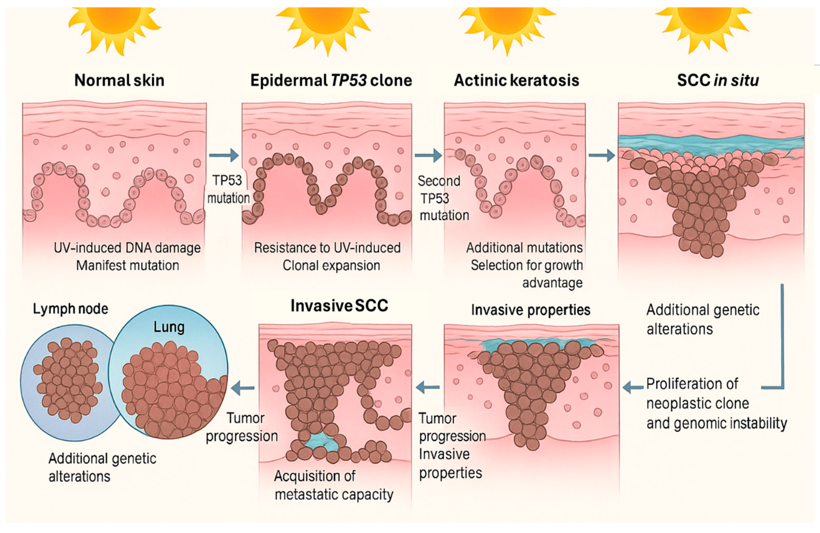 Advanced Cutaneous Squamous Cell Carcinoma: Biology, Immunotherapy, and ...