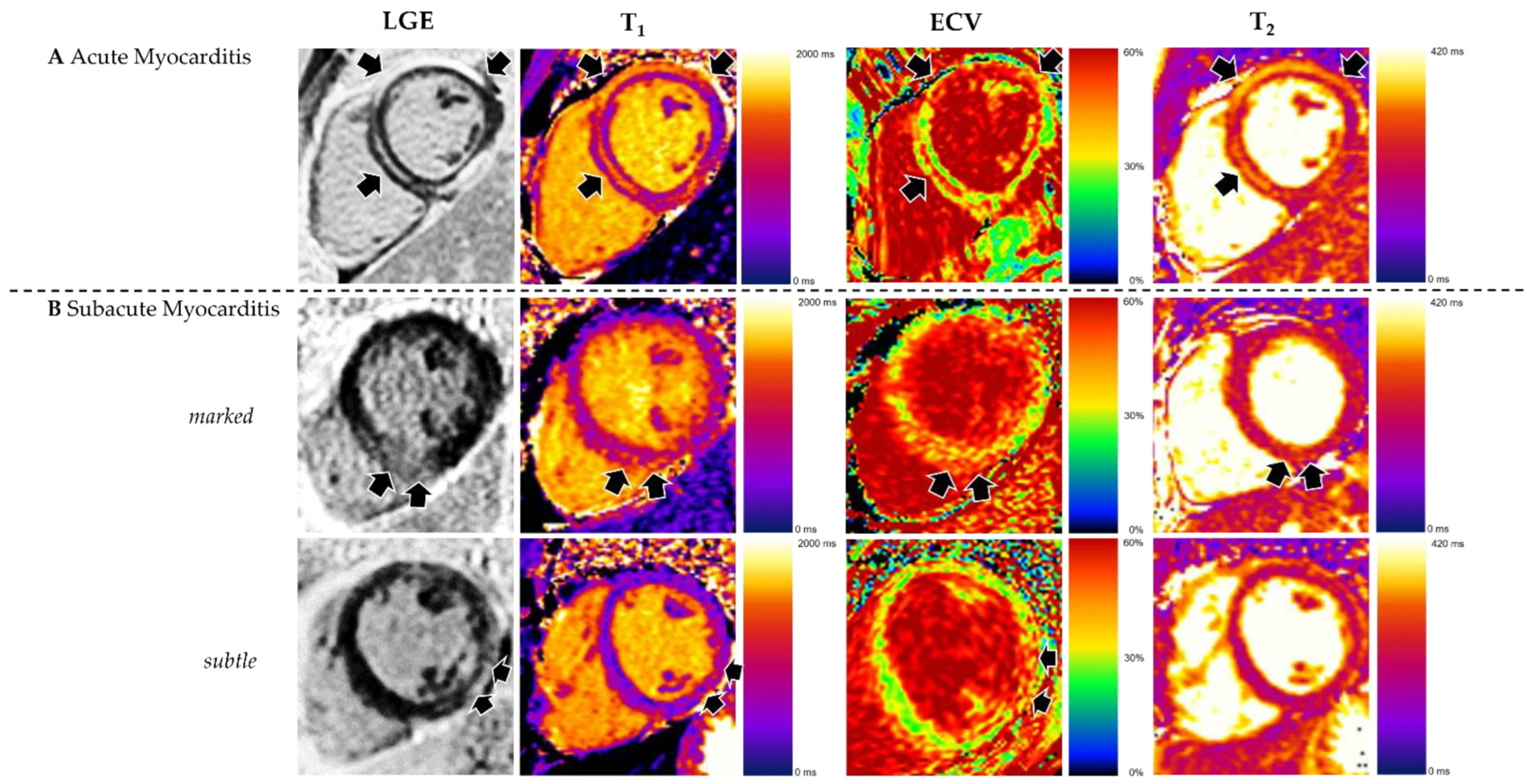 Multiparametric CMR in Myocarditis: A Comprehensive Review of ...