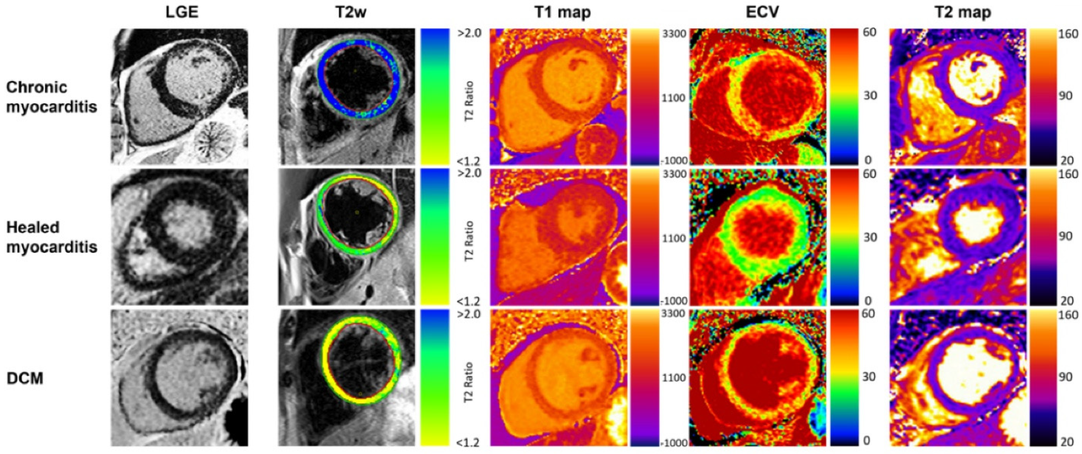 Multiparametric CMR in Myocarditis: A Comprehensive Review of ...