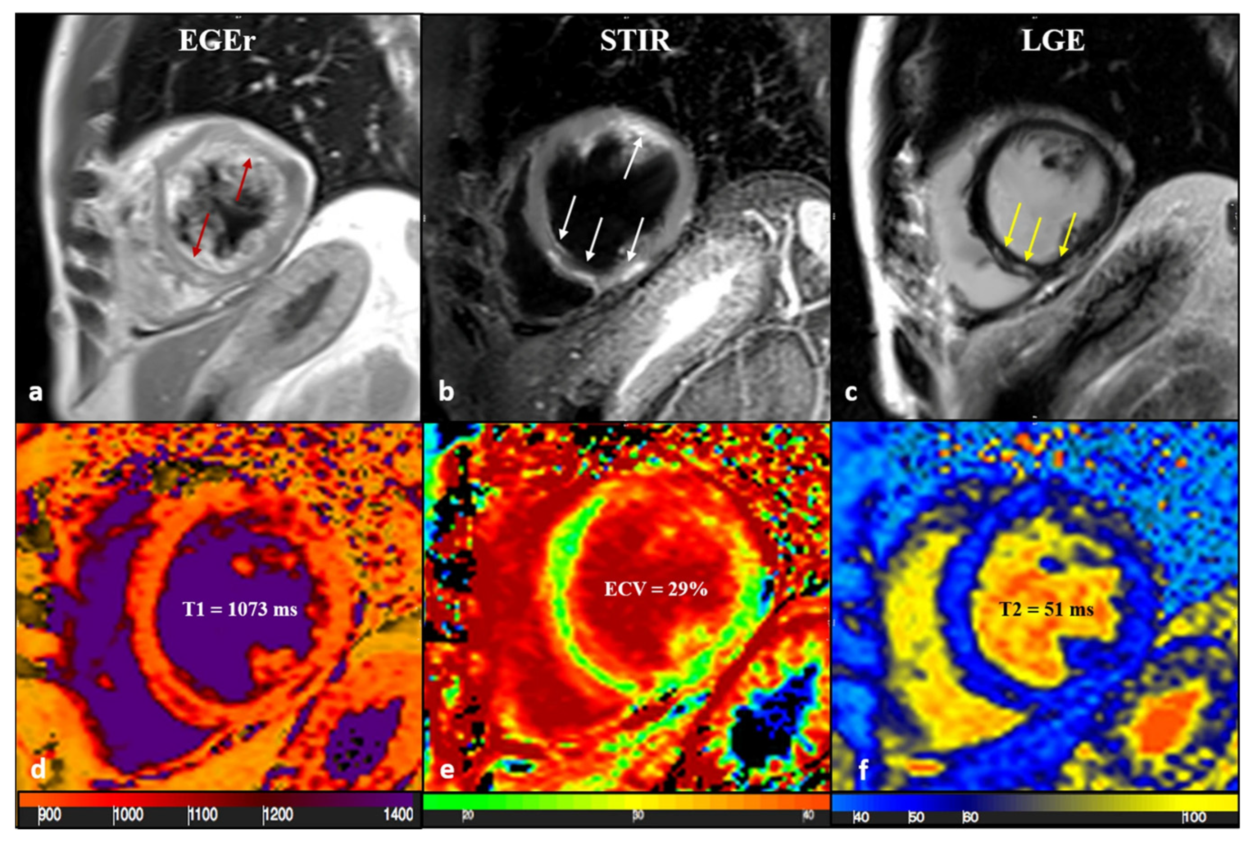 Multiparametric CMR in Myocarditis: A Comprehensive Review of ...