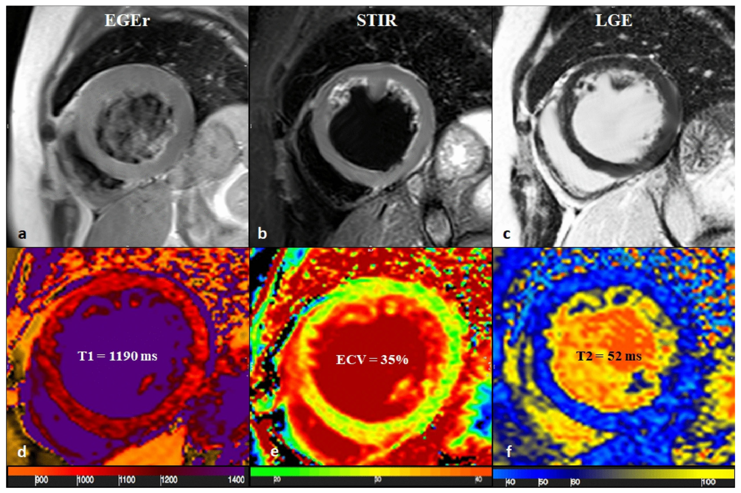 Multiparametric CMR in Myocarditis: A Comprehensive Review of ...