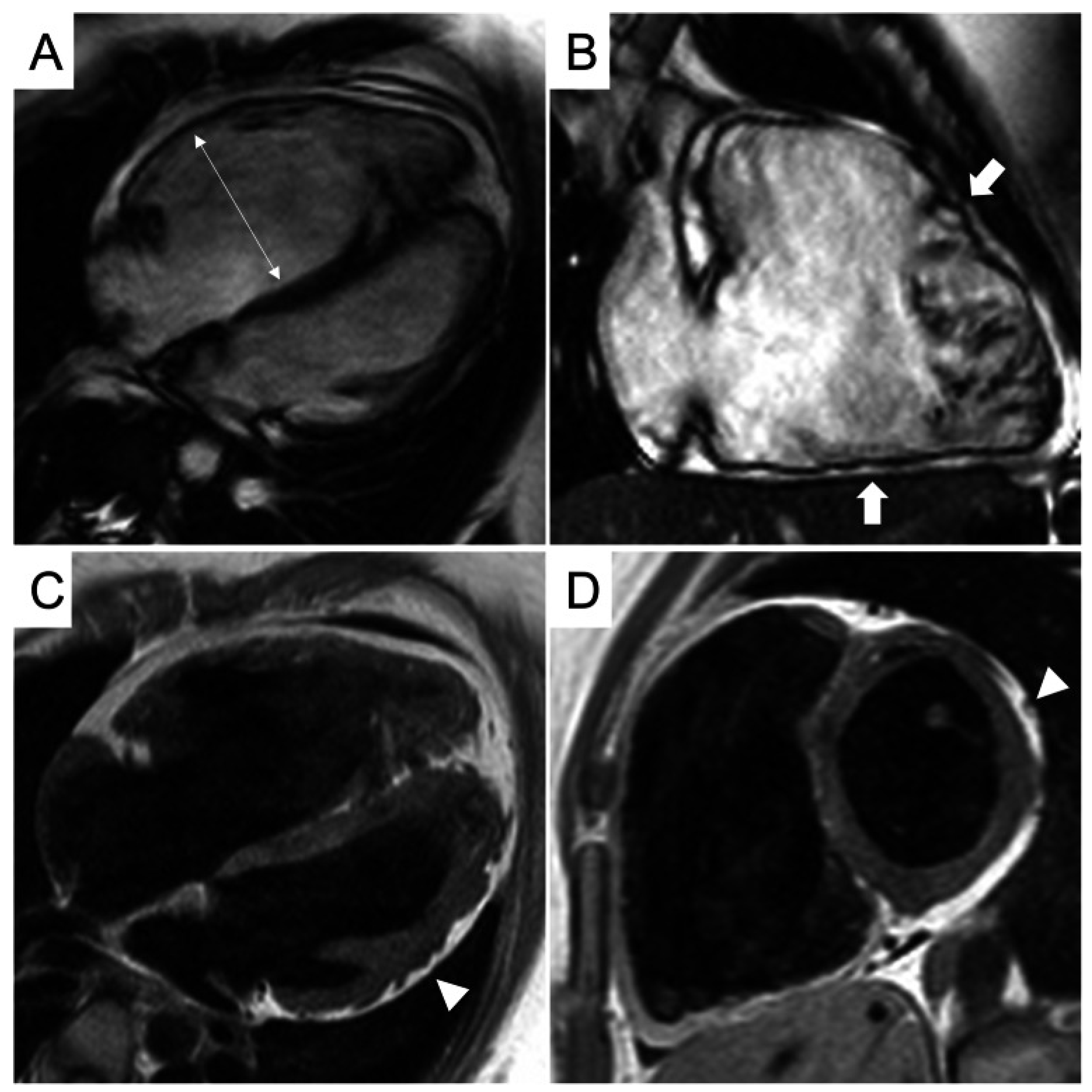 Multiparametric CMR in Myocarditis: A Comprehensive Review of ...
