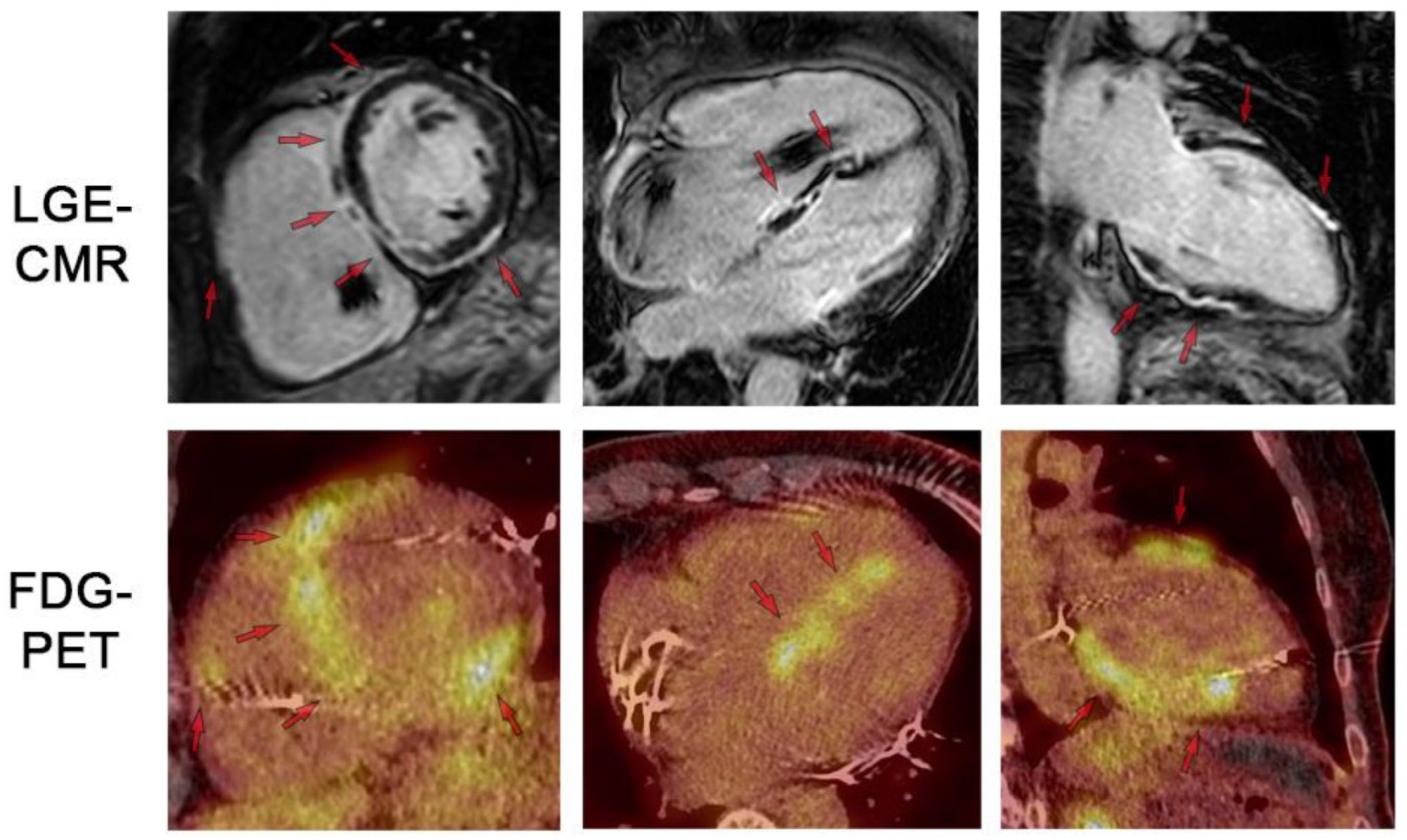 Multiparametric CMR in Myocarditis: A Comprehensive Review of ...