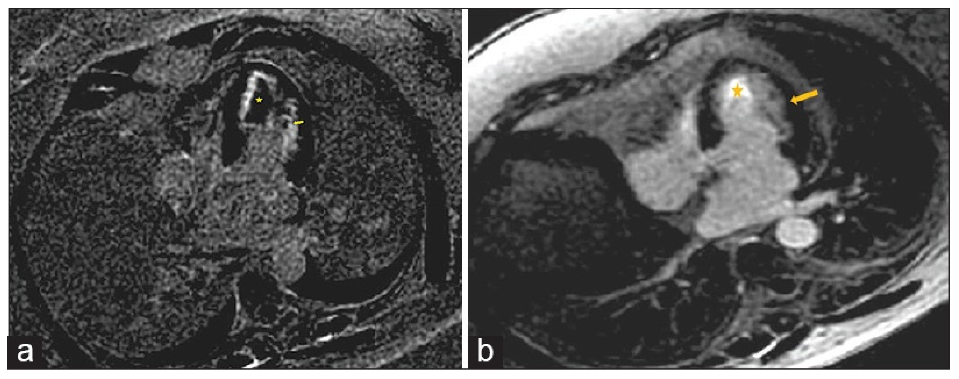 Multiparametric CMR in Myocarditis: A Comprehensive Review of ...