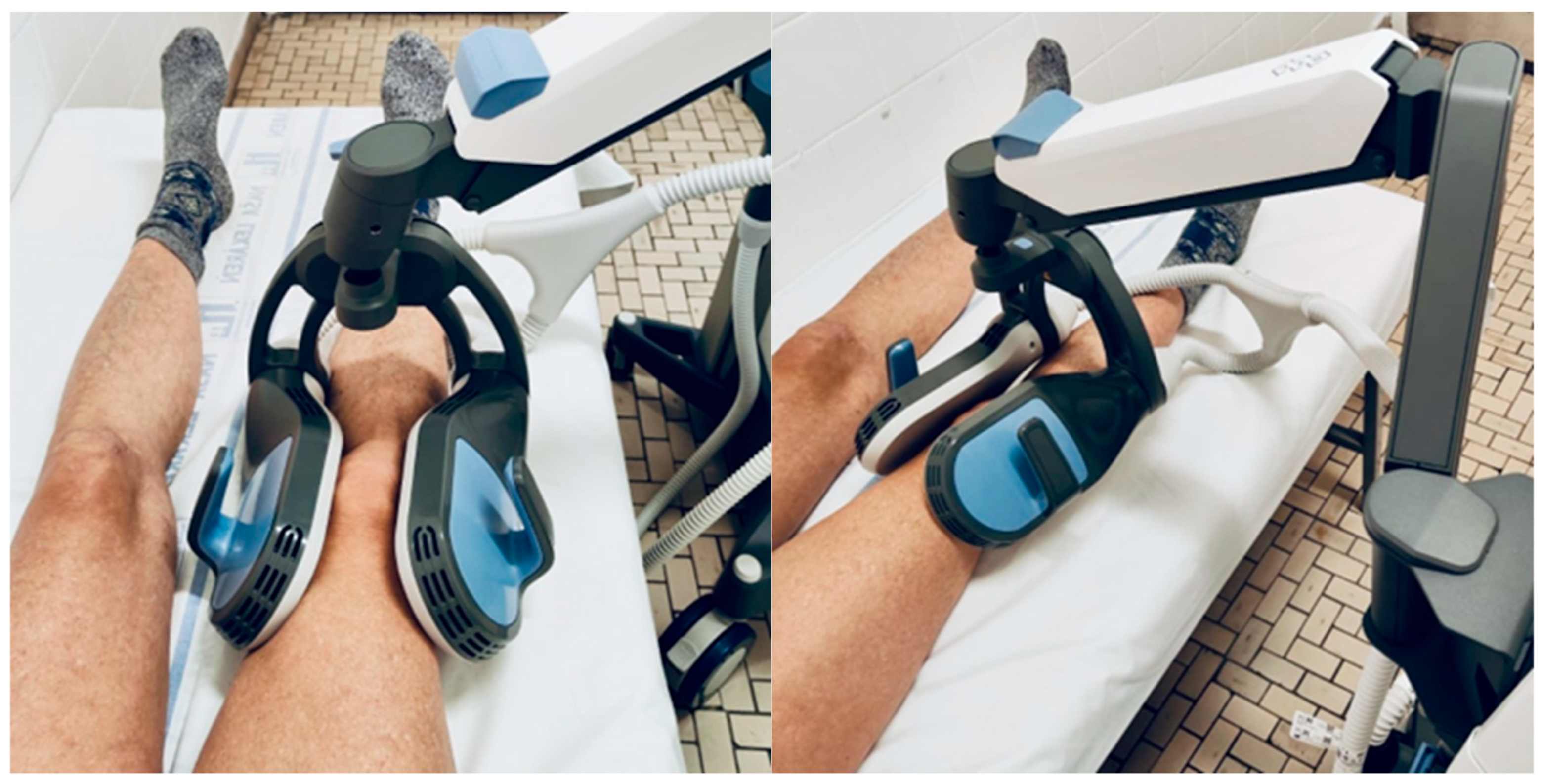 Procinus Rpm Device A Pilot Study Investigating Clinical and Functional Outcomes of Novel ...