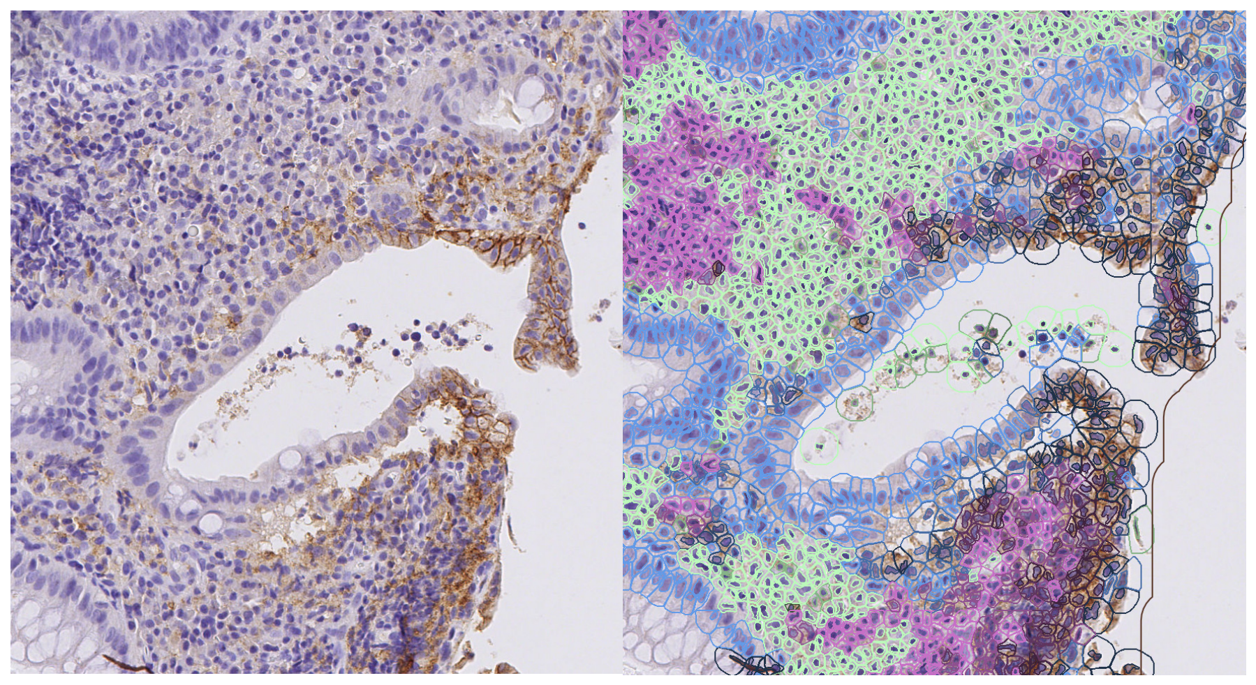 PD-1 and PD-L1 Expression in Inflammatory Bowel Disease: A Paired ...