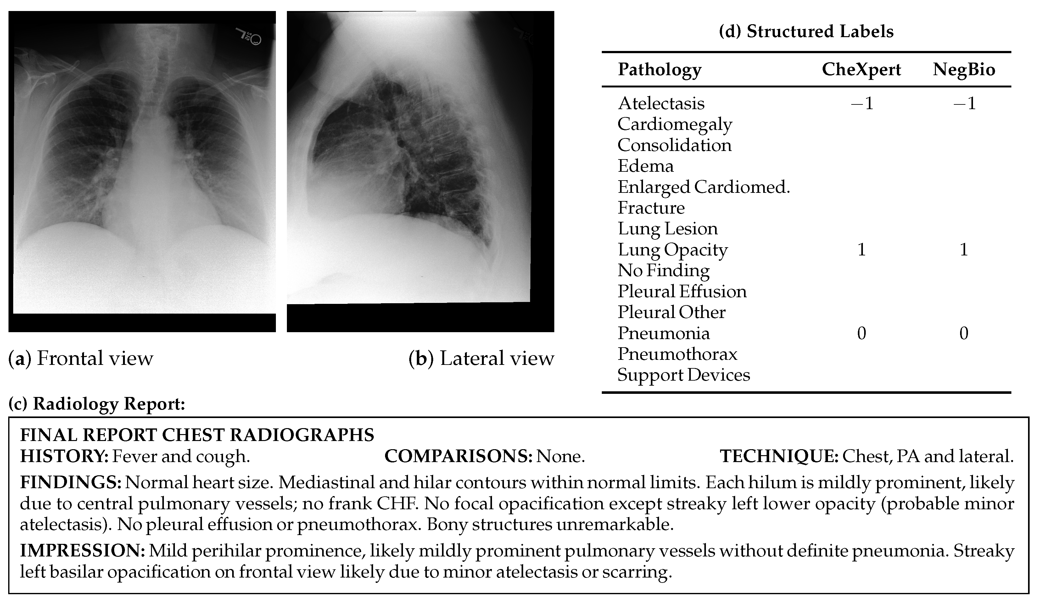 Recent Progress in Deep Learning for Chest X-Ray Report Generation