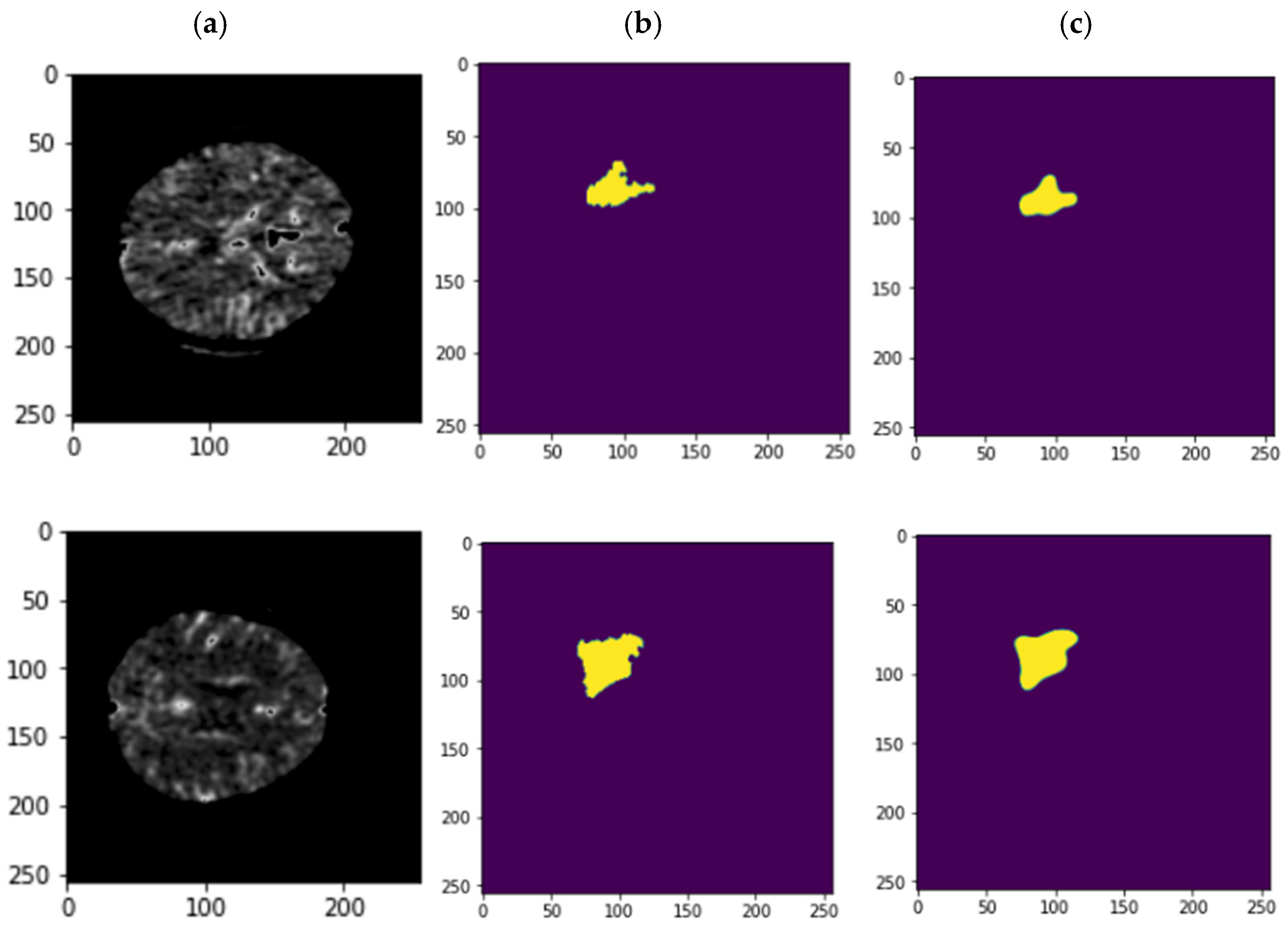 Deep Learning-Based Automatic Segmentation of Ischemic Stroke Lesions ...