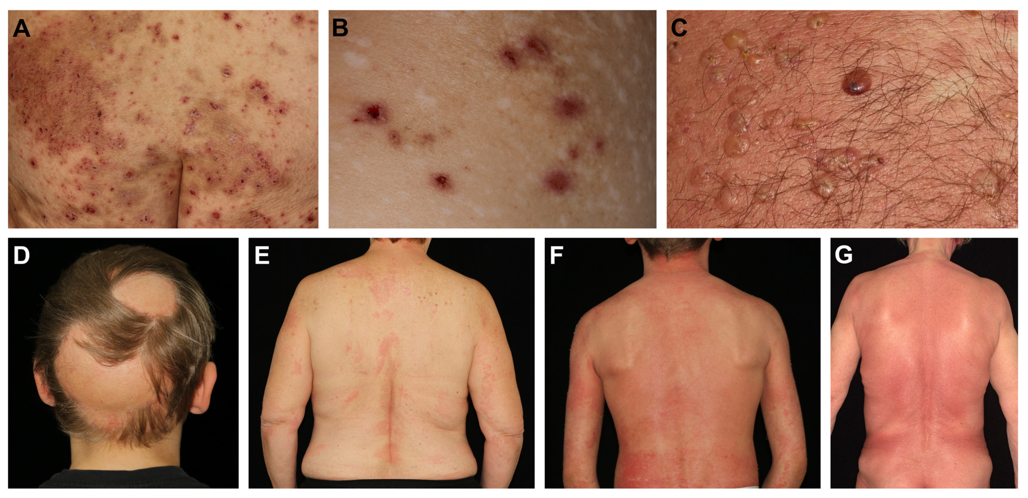 Biomolecules Free Full-Text Dupilumab in Inflammatory Skin Diseases A Systematic Review