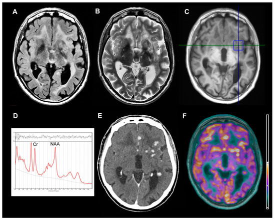 Value of Multimodal Imaging Approach to Diagnosis of Neurosarcoidosis