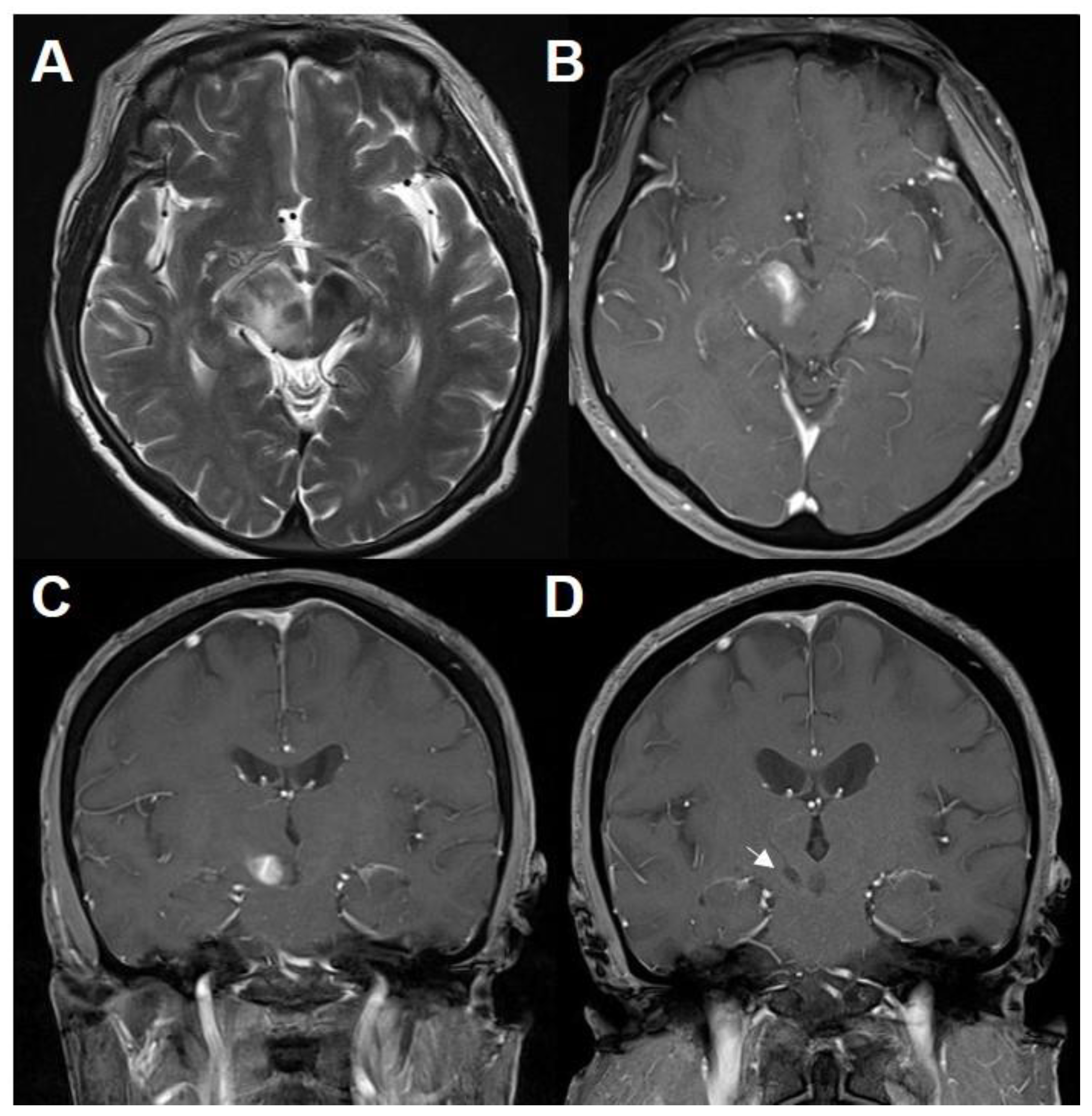 Neuroimaging in Multiple Sclerosis and Its Mimics (Chapter 6) - Multiple  Sclerosis