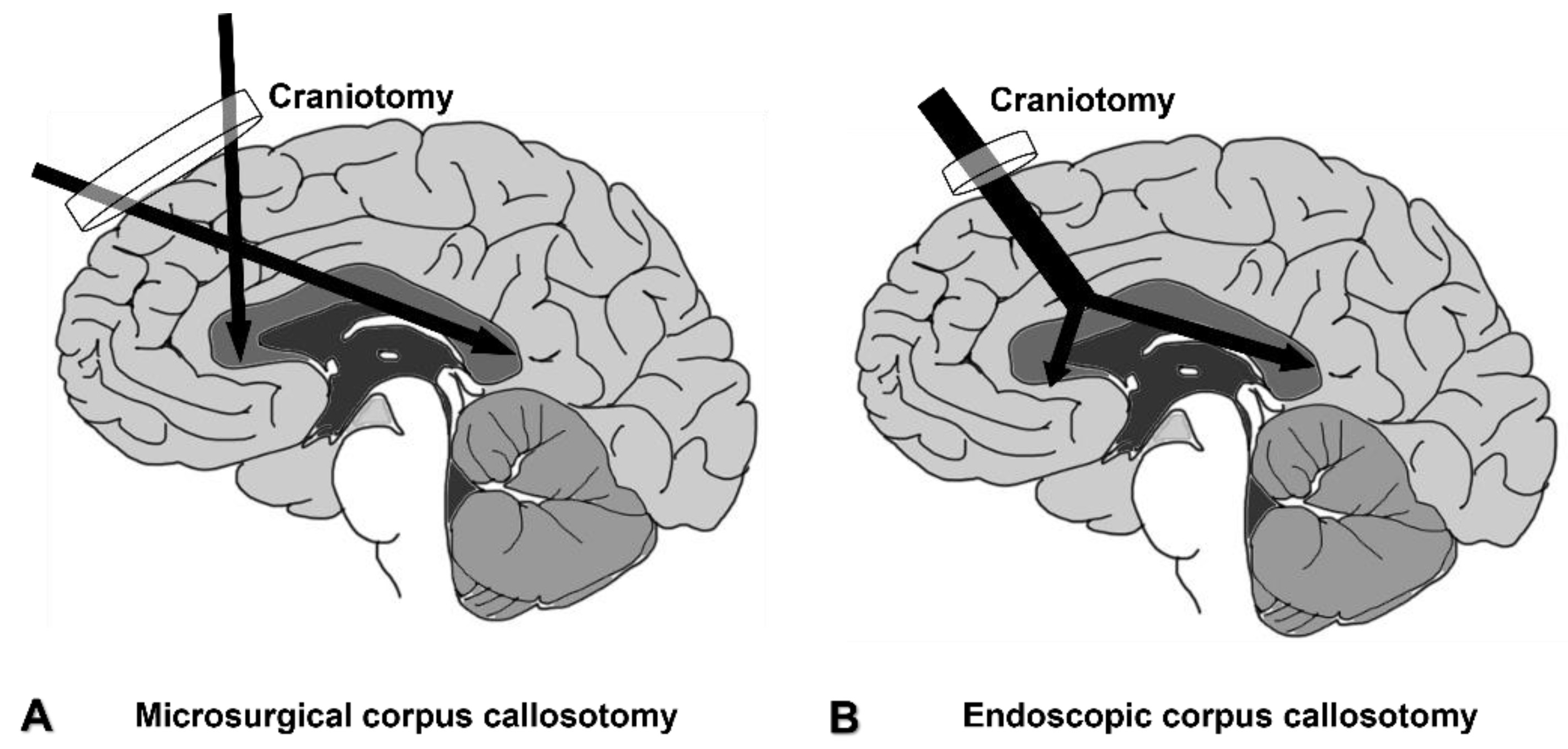 Surgical Aspects Of Corpus Callosotomy Surgical Aspects Of Corpus Callosotomy