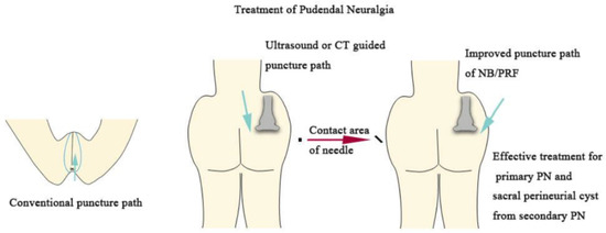 Pudendal Nerve Block - Imaging Glossary - Patients - UR Medicine Imaging  Sciences (Radiology) - University of Rochester Medical Center