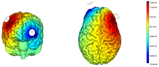 tDCS Anodal Stimulation of the Right Dorsolateral Prefrontal Cortex ...