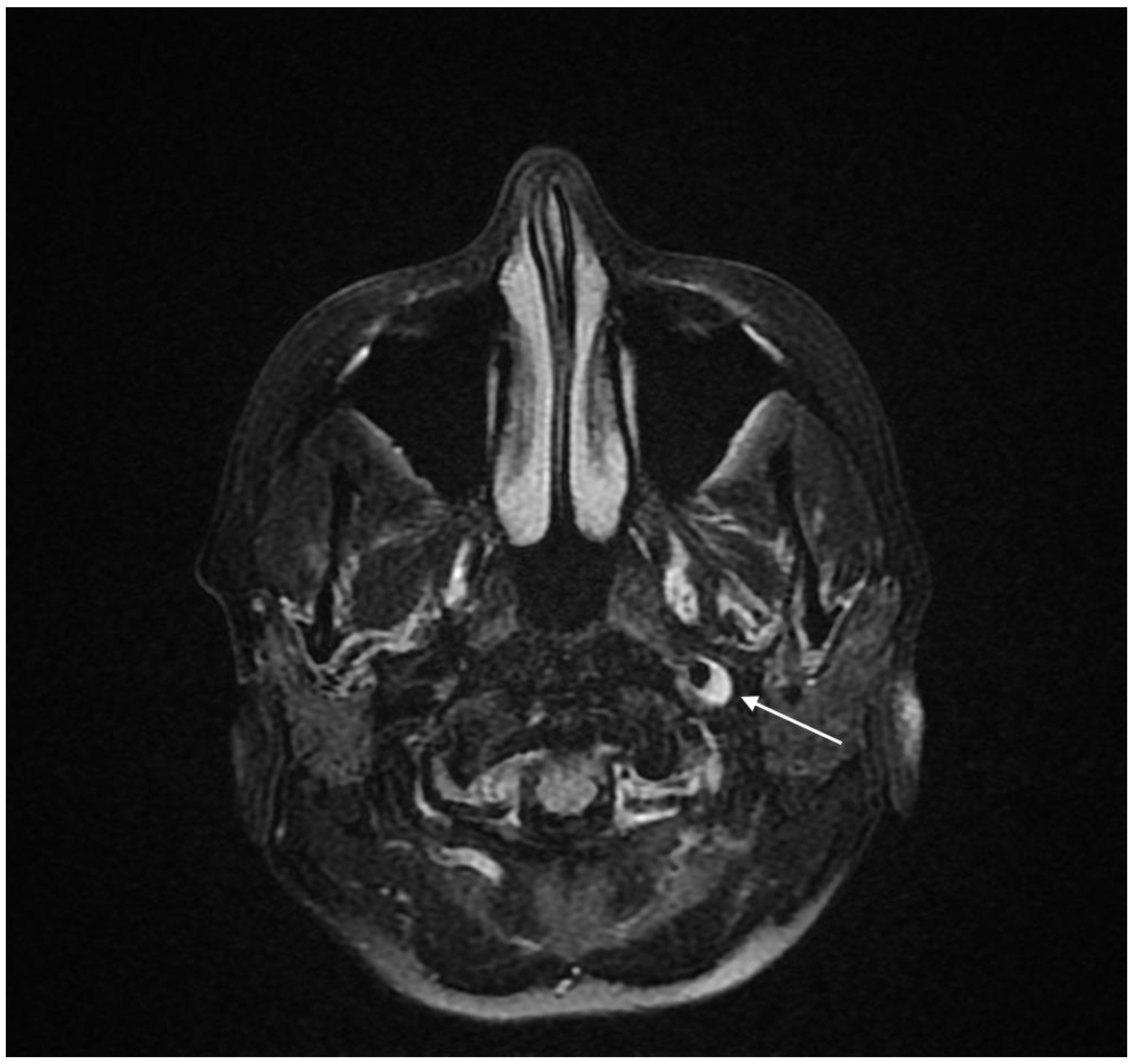 Clinical photograph showing the swelling in the mandibu
